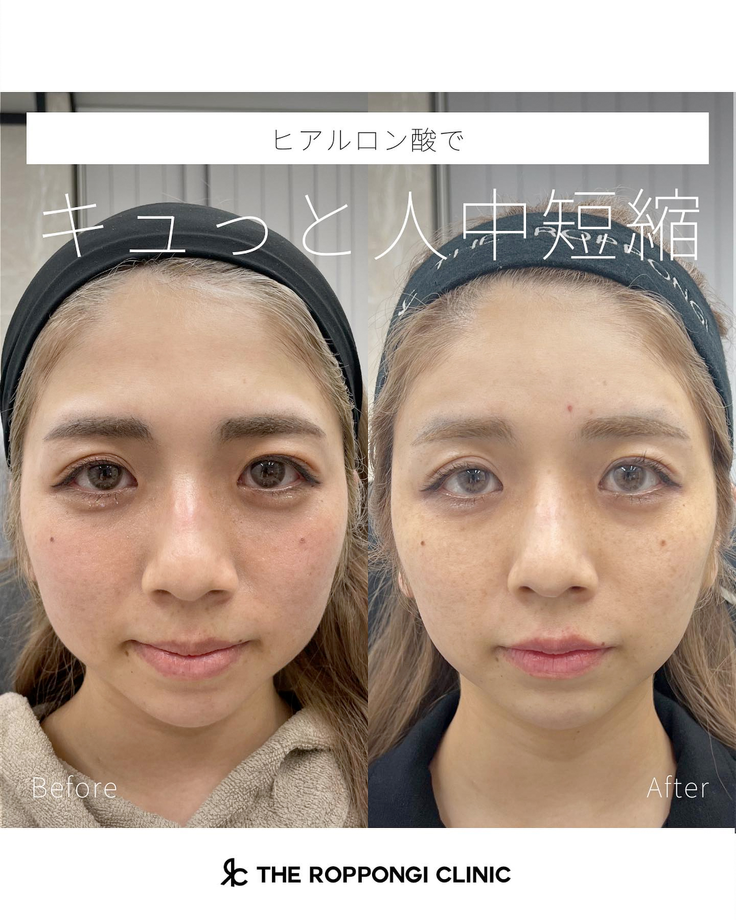 ヒアルロン酸でキュッと人中短縮