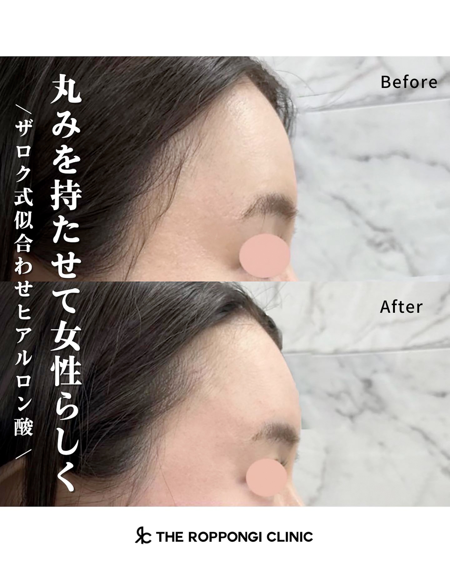 ヒアルロン酸注射、小顔治療