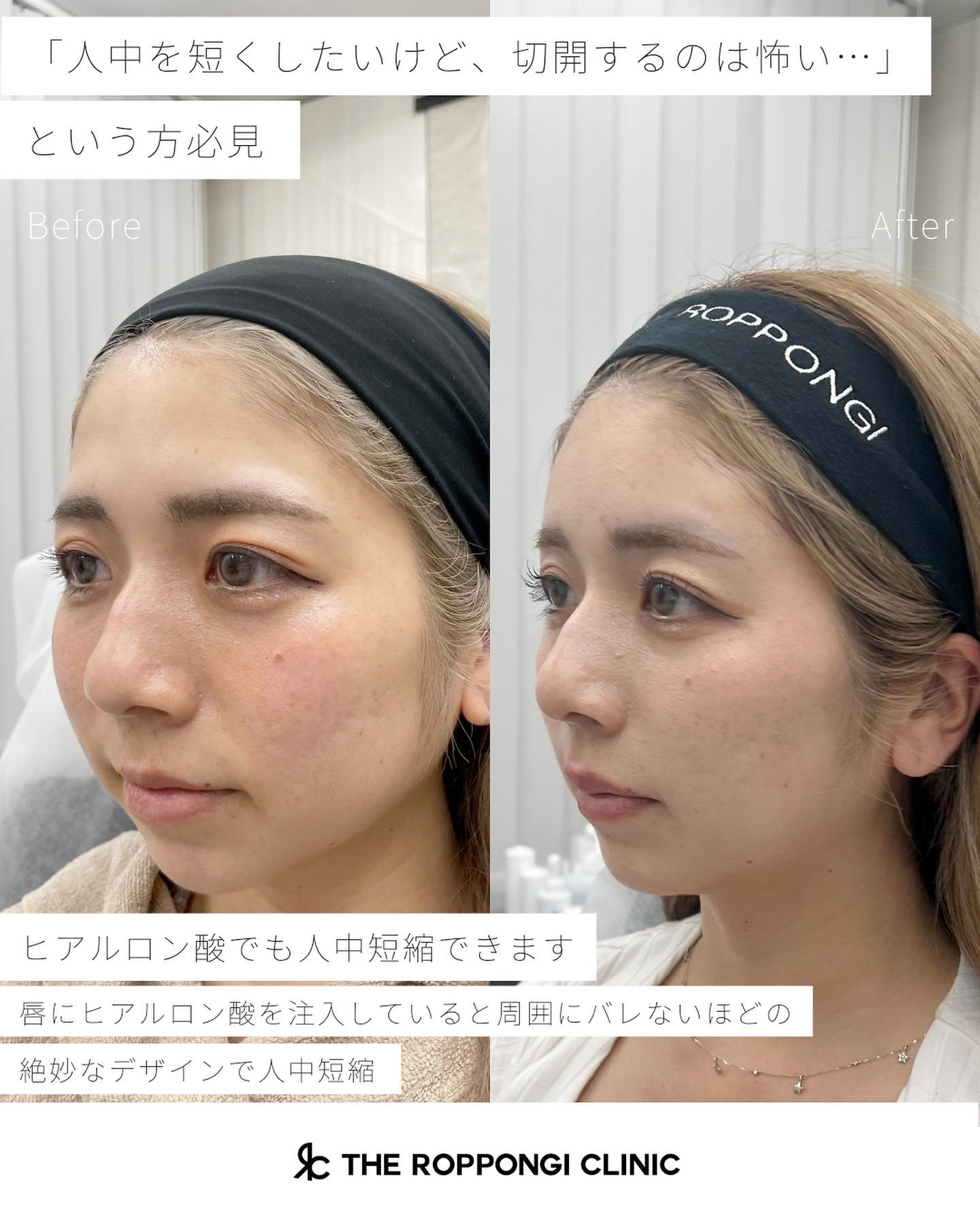 ヒアルロン酸注射、人中短縮