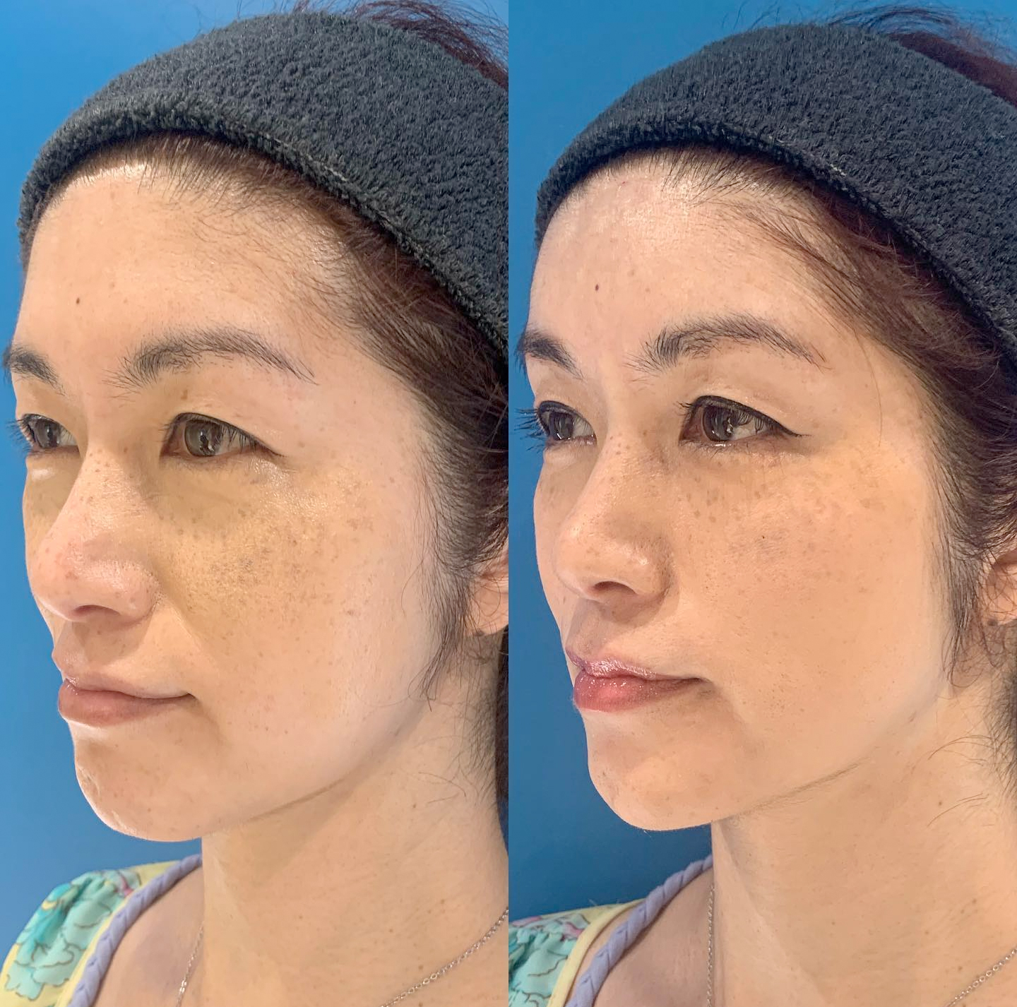 似合わせヒアルロン酸注射®︎で本来の美しさと若返りを手にいれる