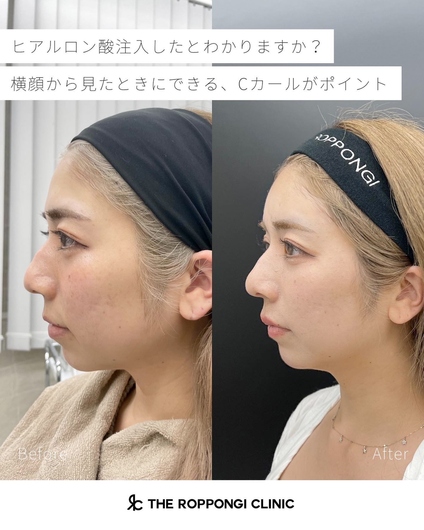 ヒアルロン酸注射、人中短縮