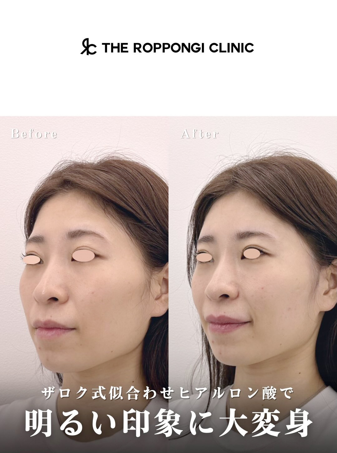 ザロク式似合わせヒアルロン酸®︎で明るい印象に大変身