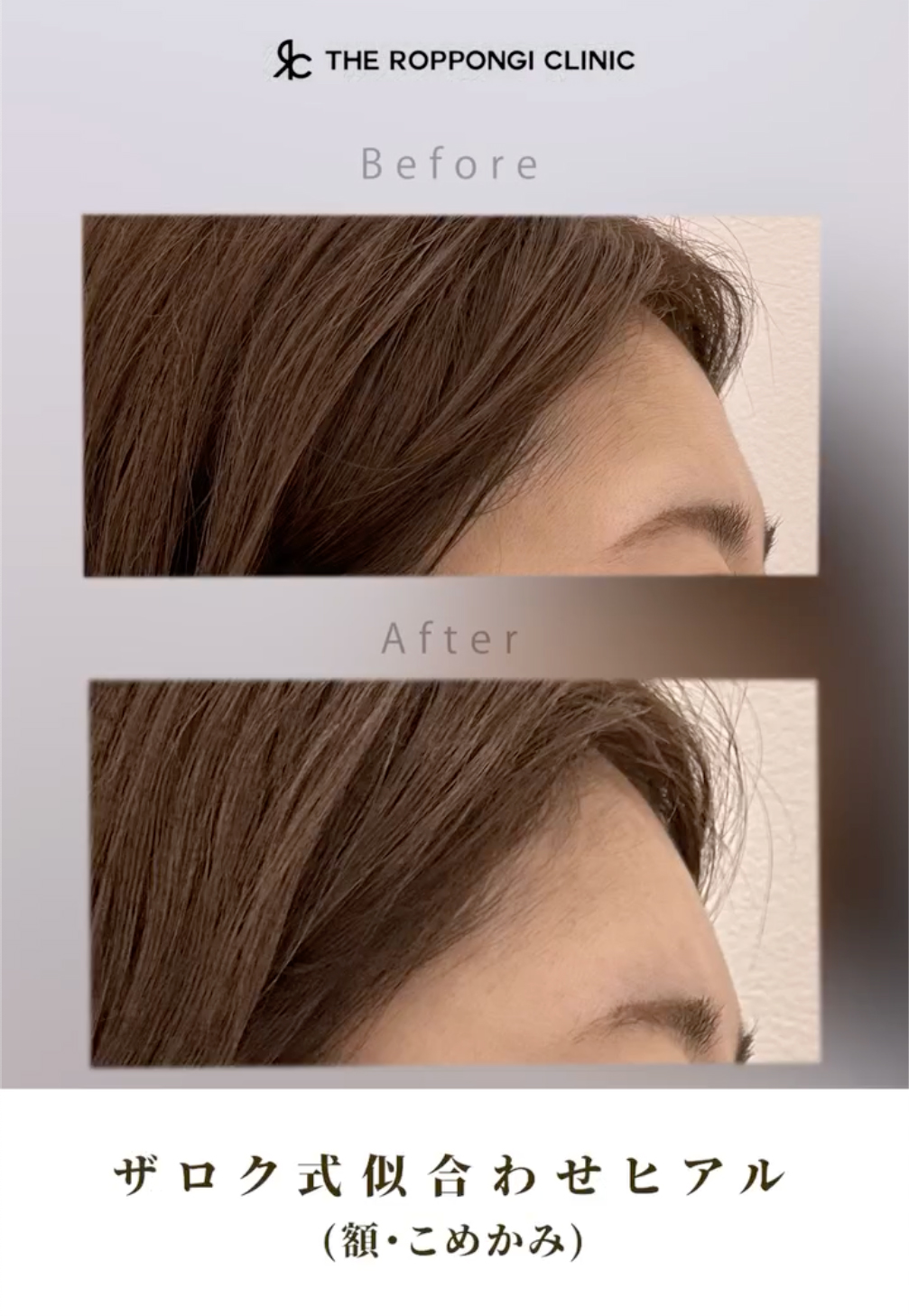 ヒアルロン酸注射、たるみ治療