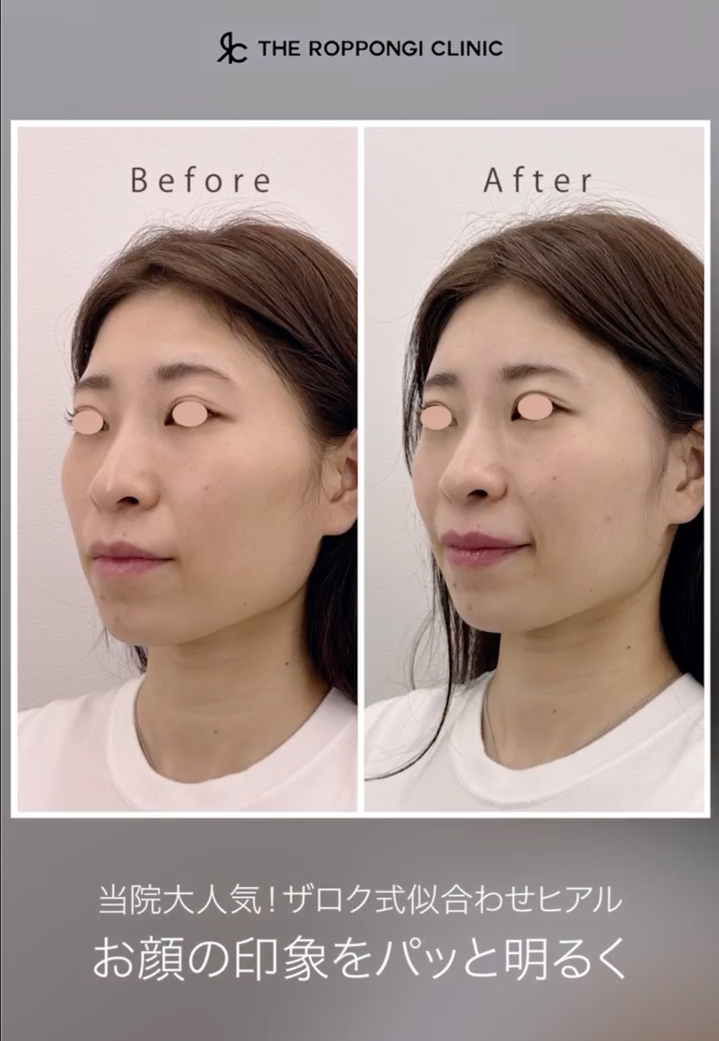 ヒアルロン酸注射、たるみ治療