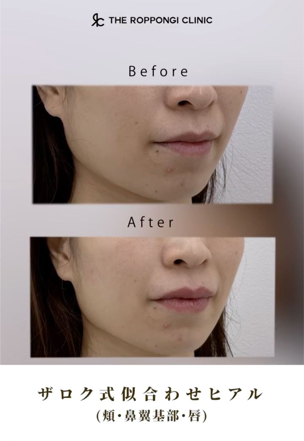 ヒアルロン酸注射、若返り