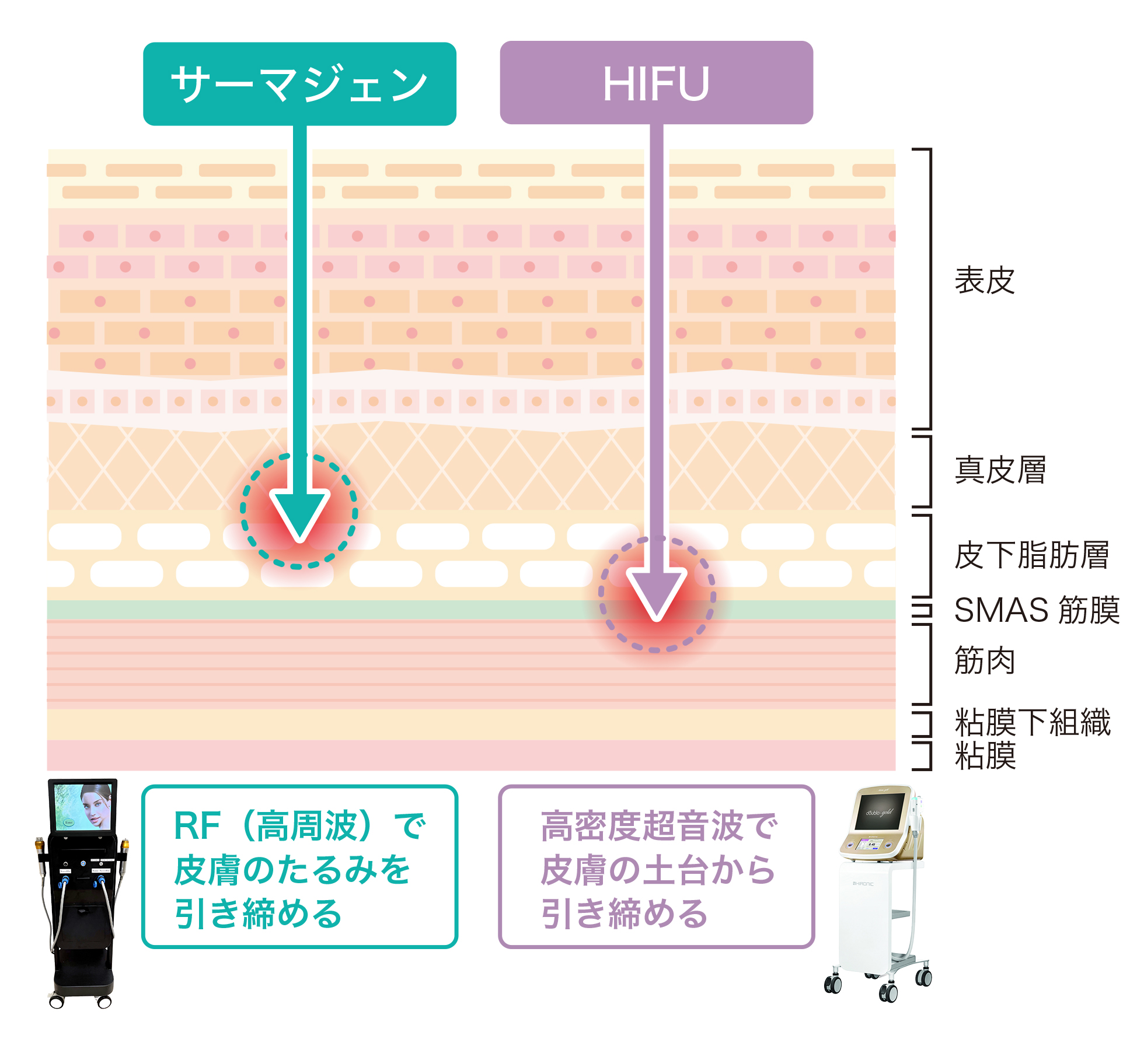 サーマジェンとHIFUの違い