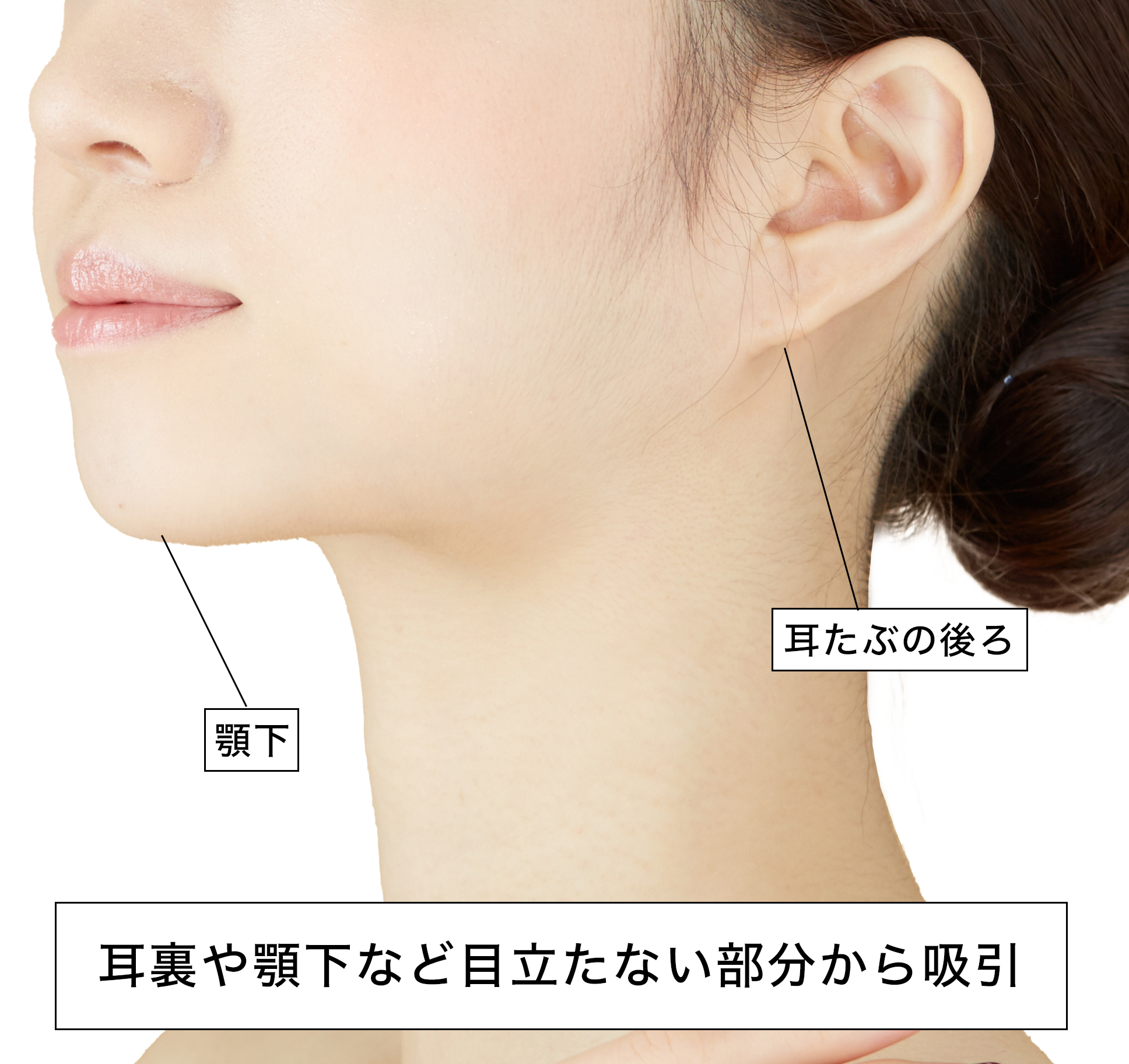 耳裏や顎下など目立ちにくい部分から吸引