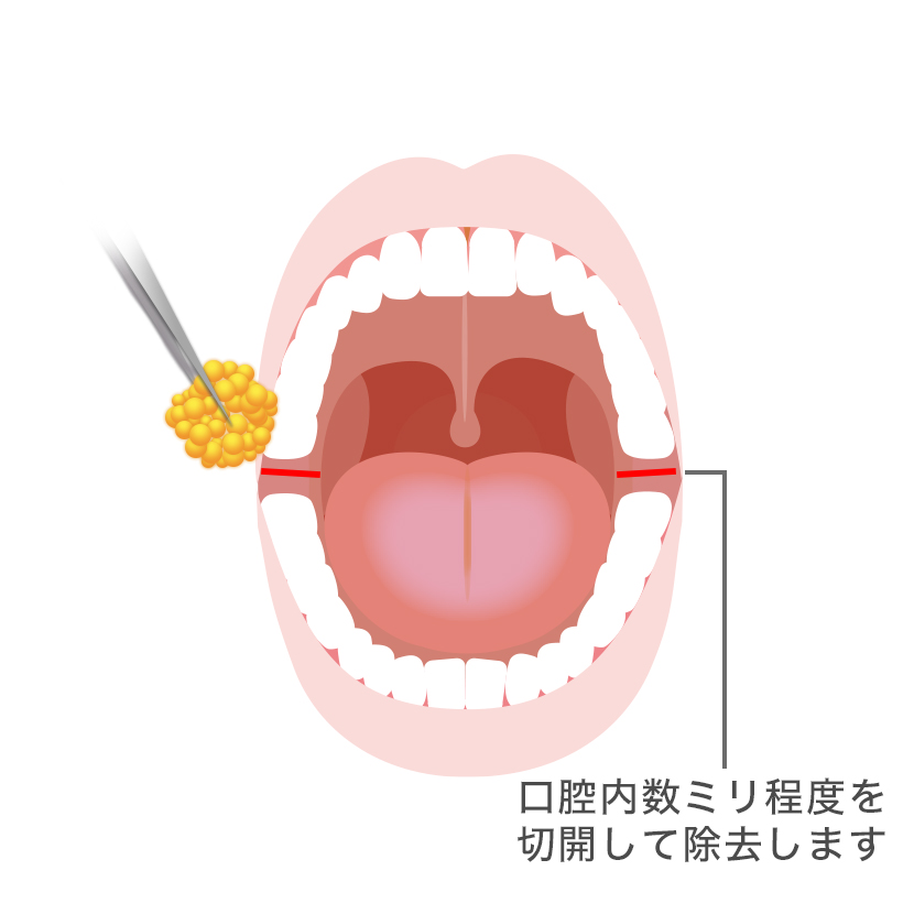 バッカルファット除去
