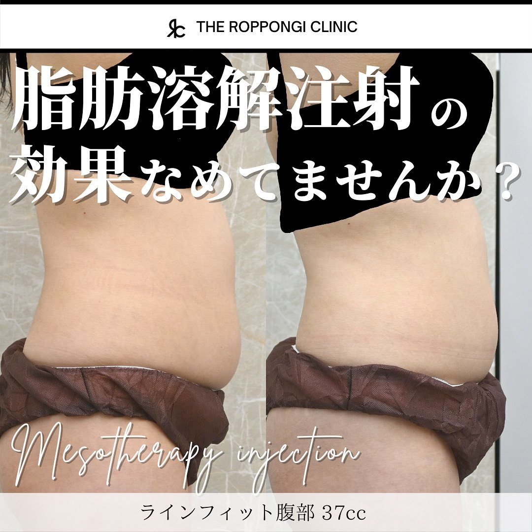 脂肪溶解注射による腹部の部分痩身