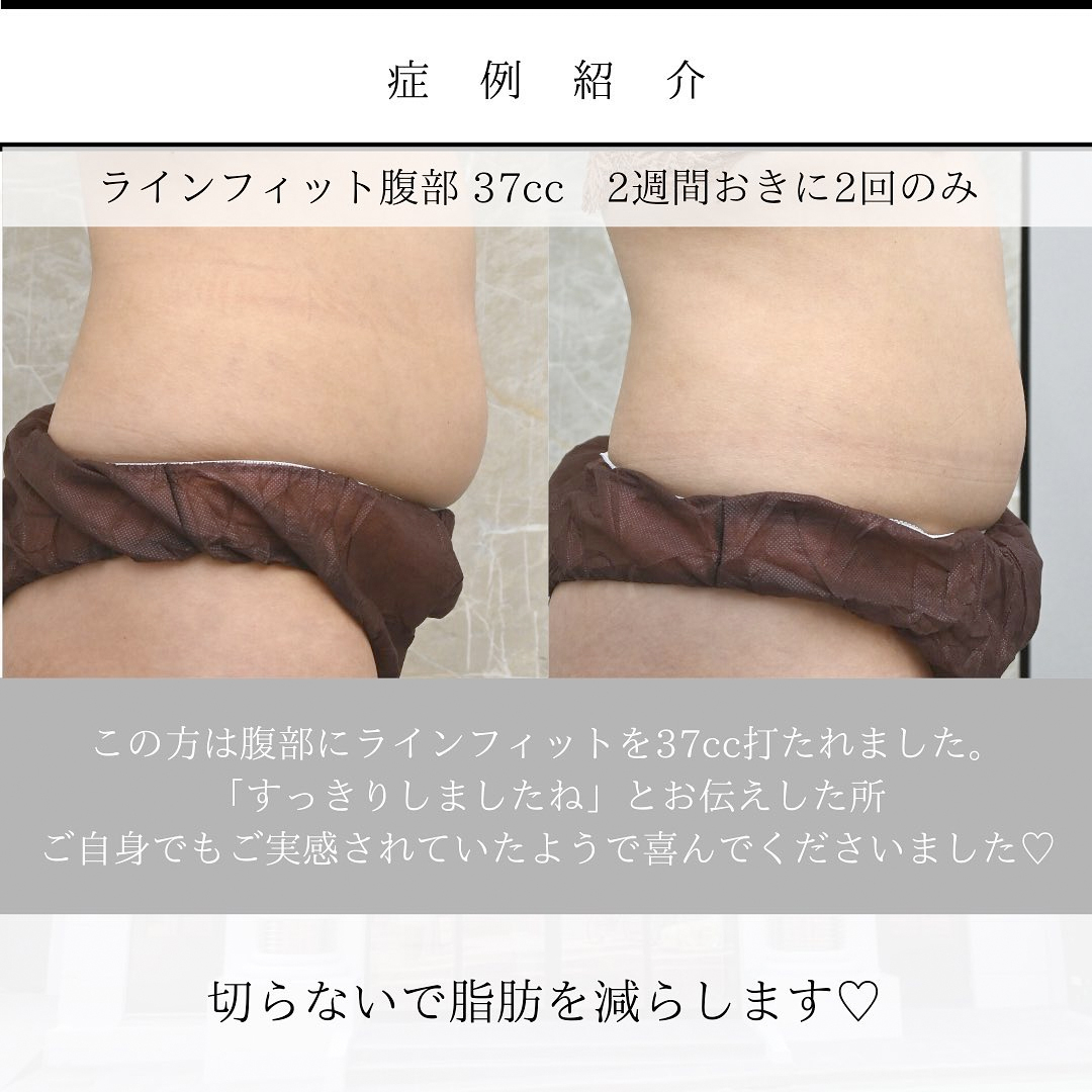 腹部への脂肪溶解注射