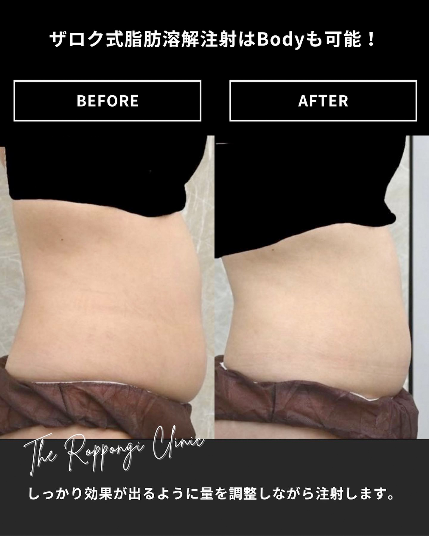 腹部への脂肪溶解注射