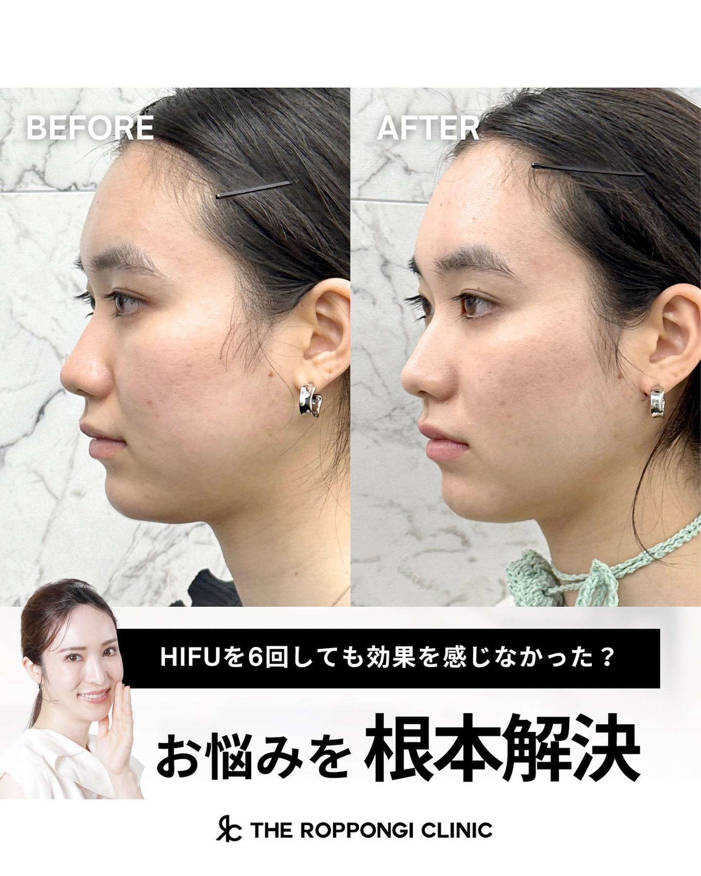 【お悩みを根本解決】HIFUを6回しても効果を感じなかった?!