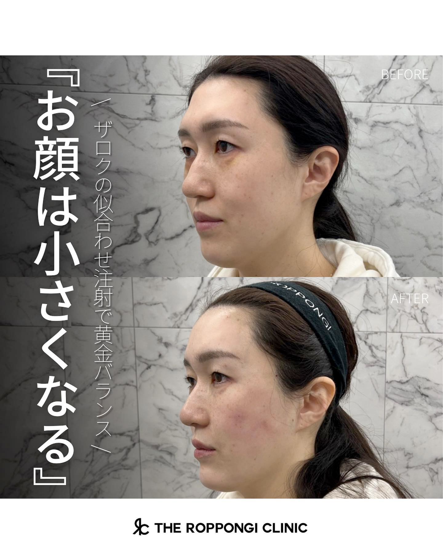 【お顔は小さくなる】ザロクの似合わせヒアルロン酸®︎で黄金バランス