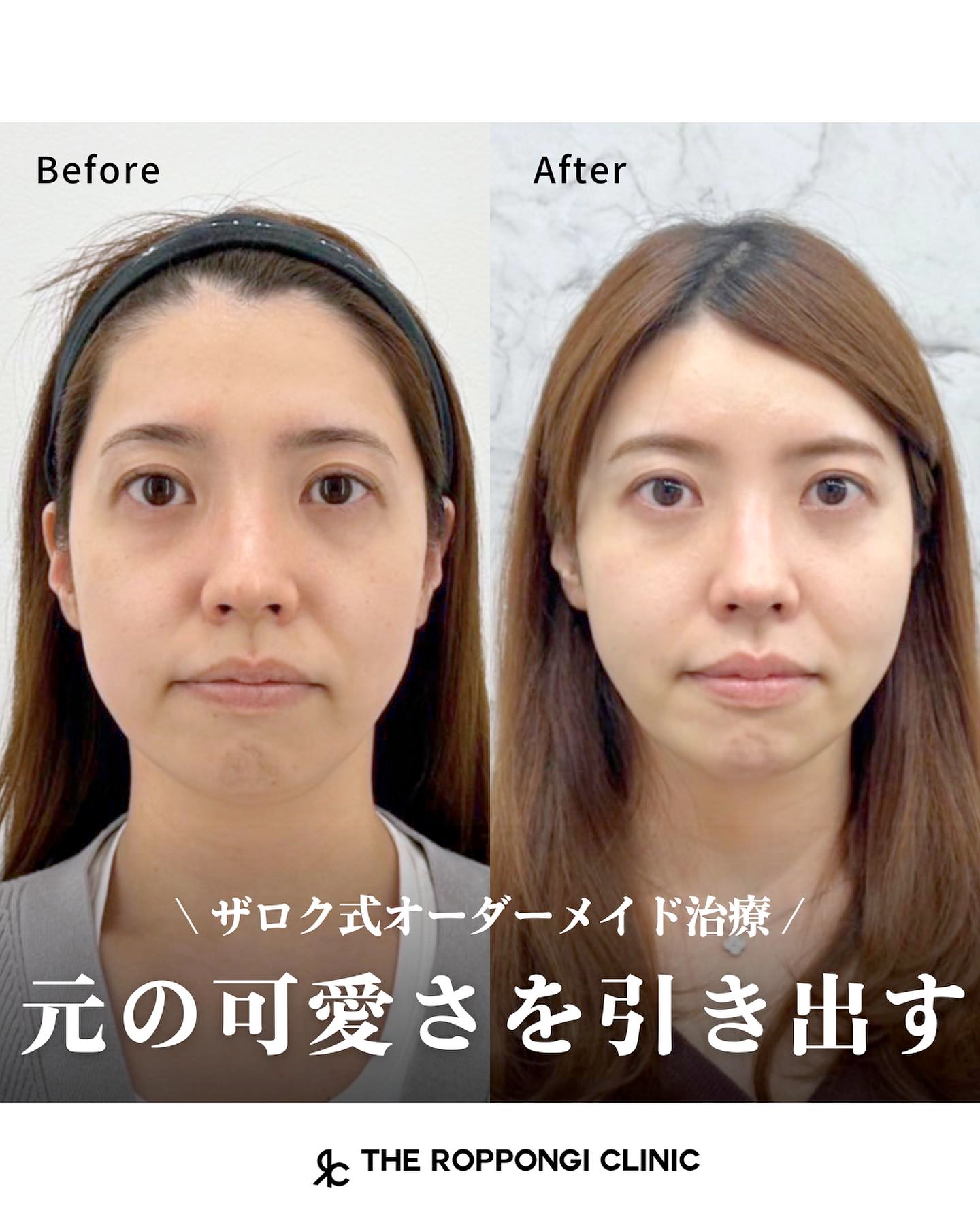 女性らしい丸みを作るザロク式似合わせヒアルロン酸®︎