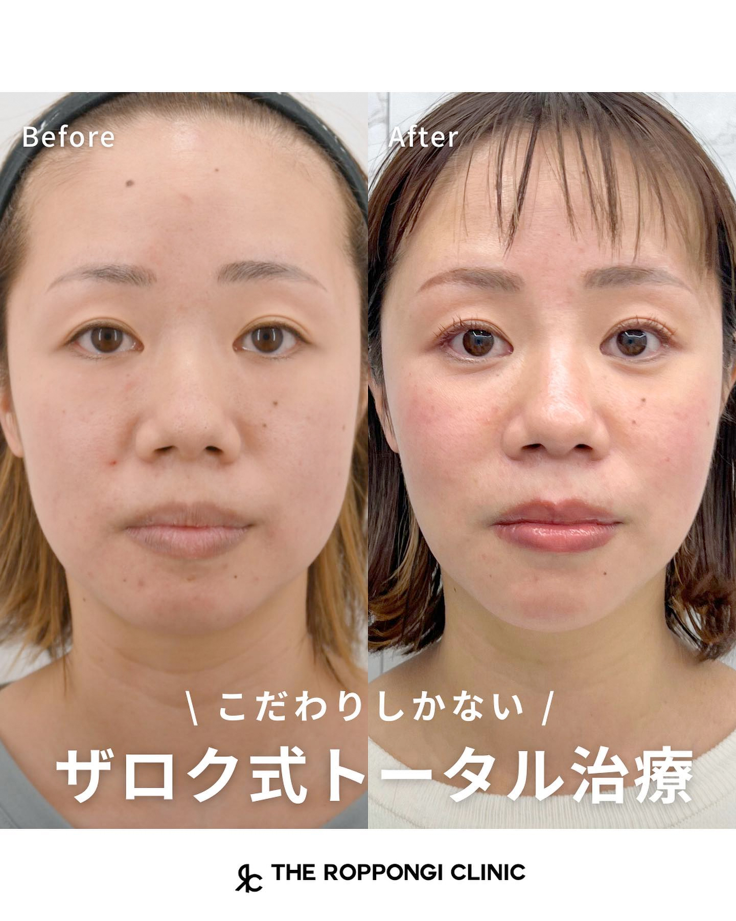 ザロク式トータル治療 小顔形成