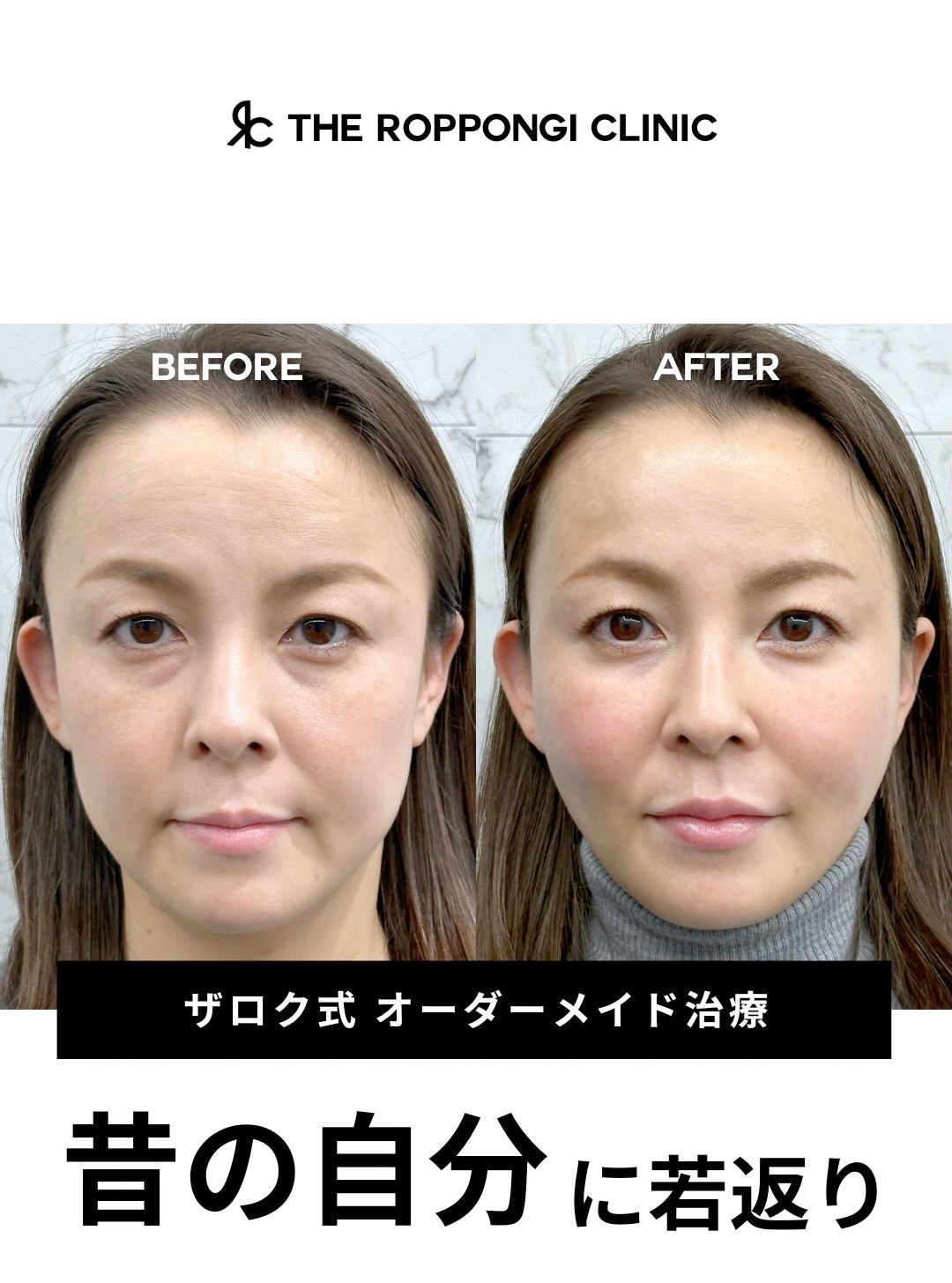 【ザロク式オーダーメイド治療】昔の自分に若返り