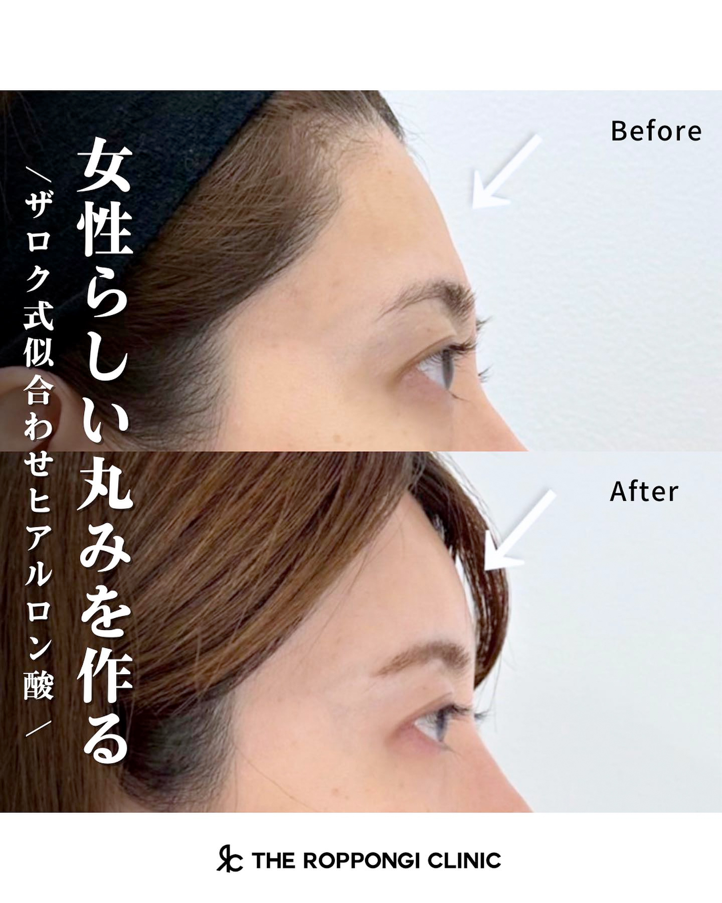 額のヒアルロン酸注入