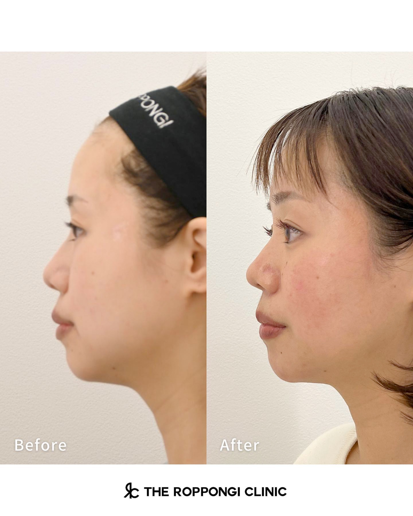 バッカルファット、脂肪溶解注射、小顔治療