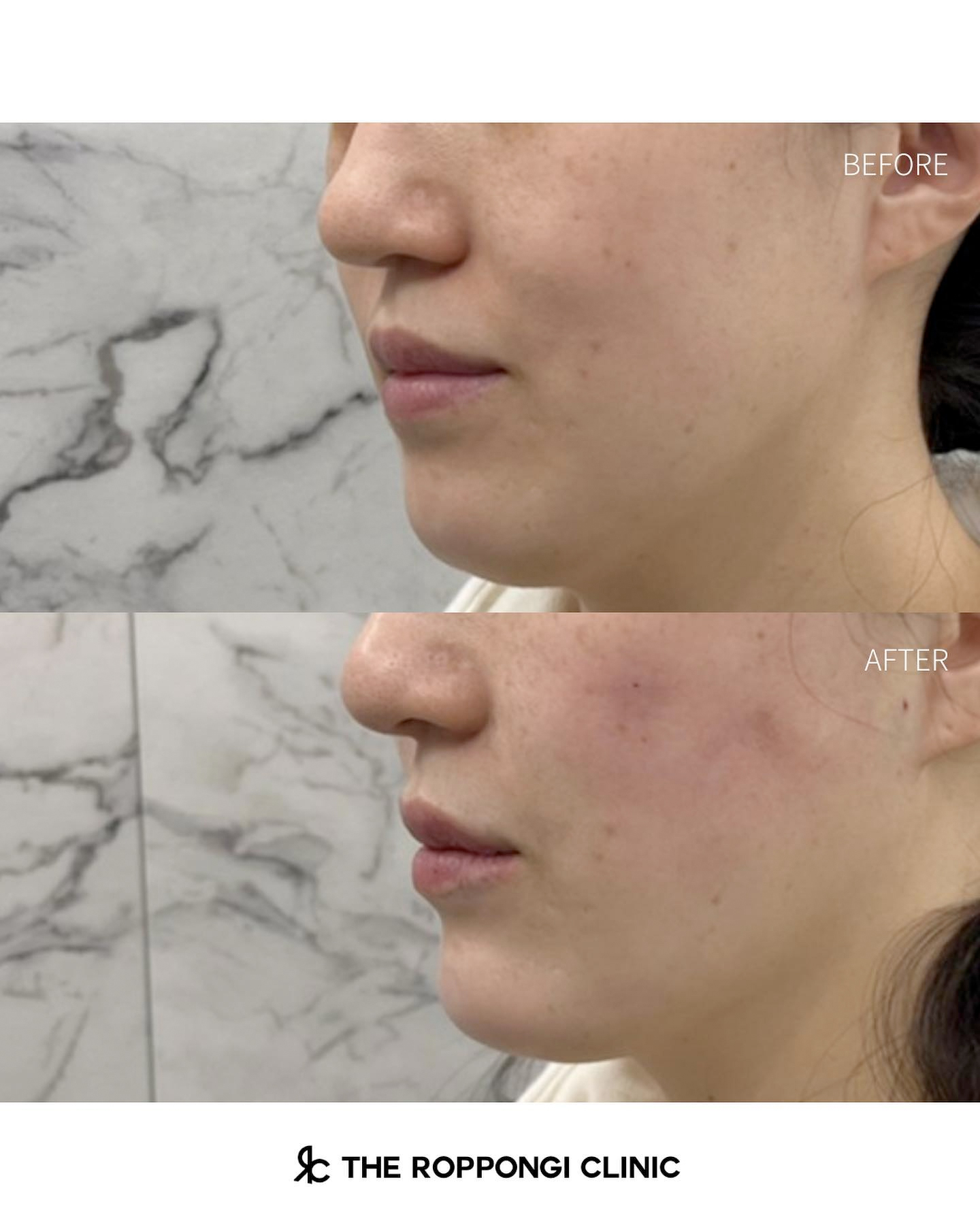 ヒアルロン酸注射