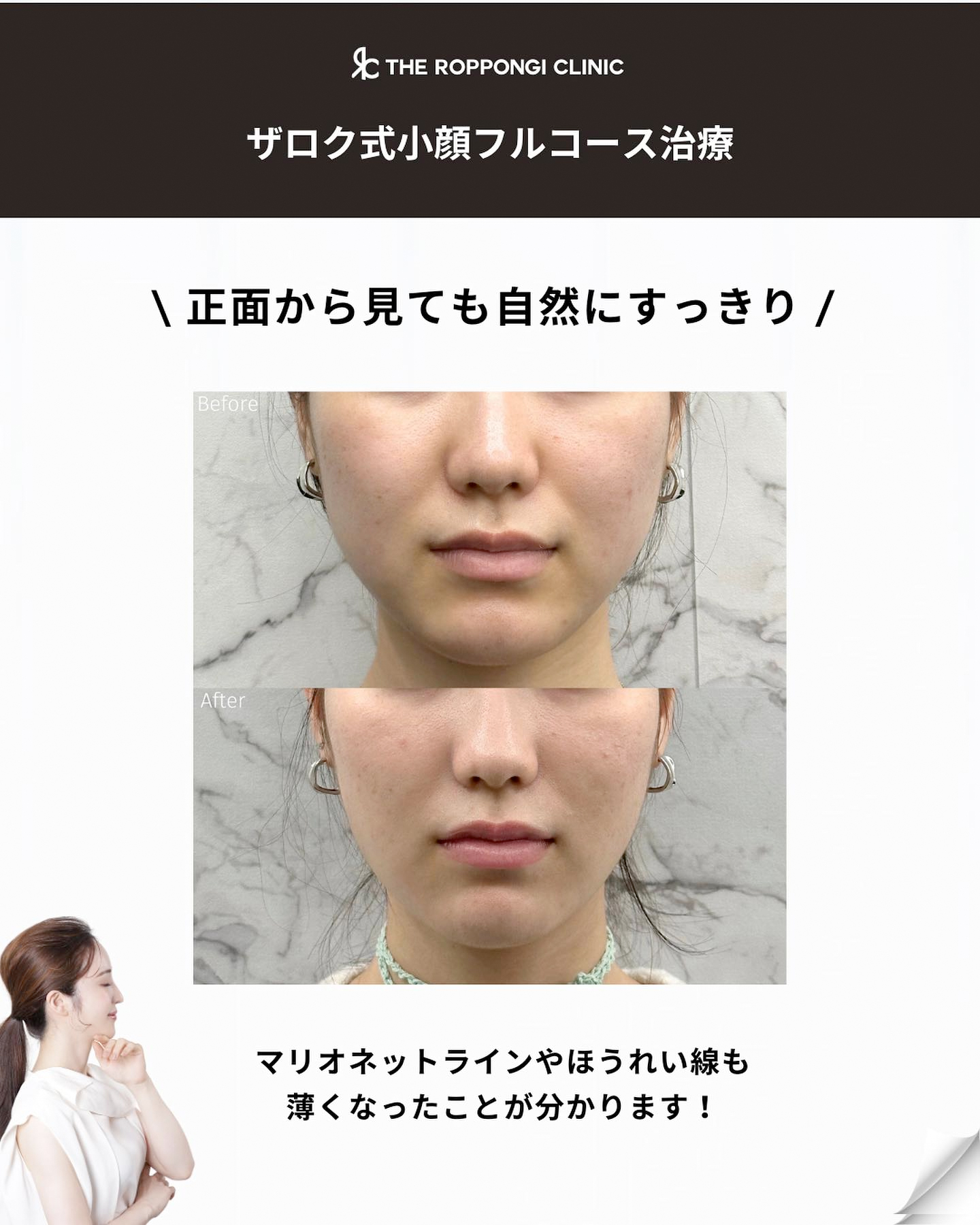 バッカルファット、脂肪吸引