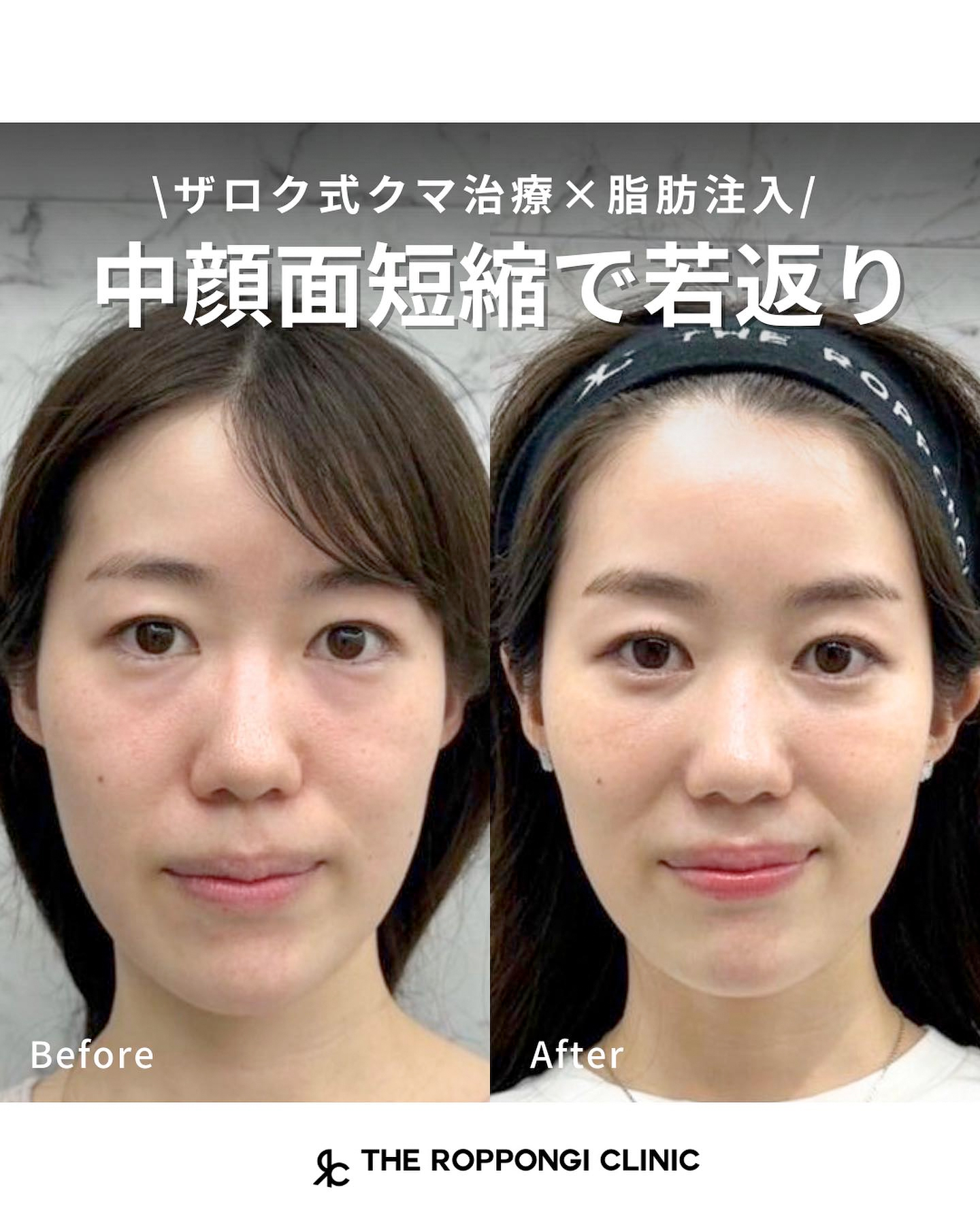 【ザロク式クマ治療×脂肪注入】中顔面短縮で若返り