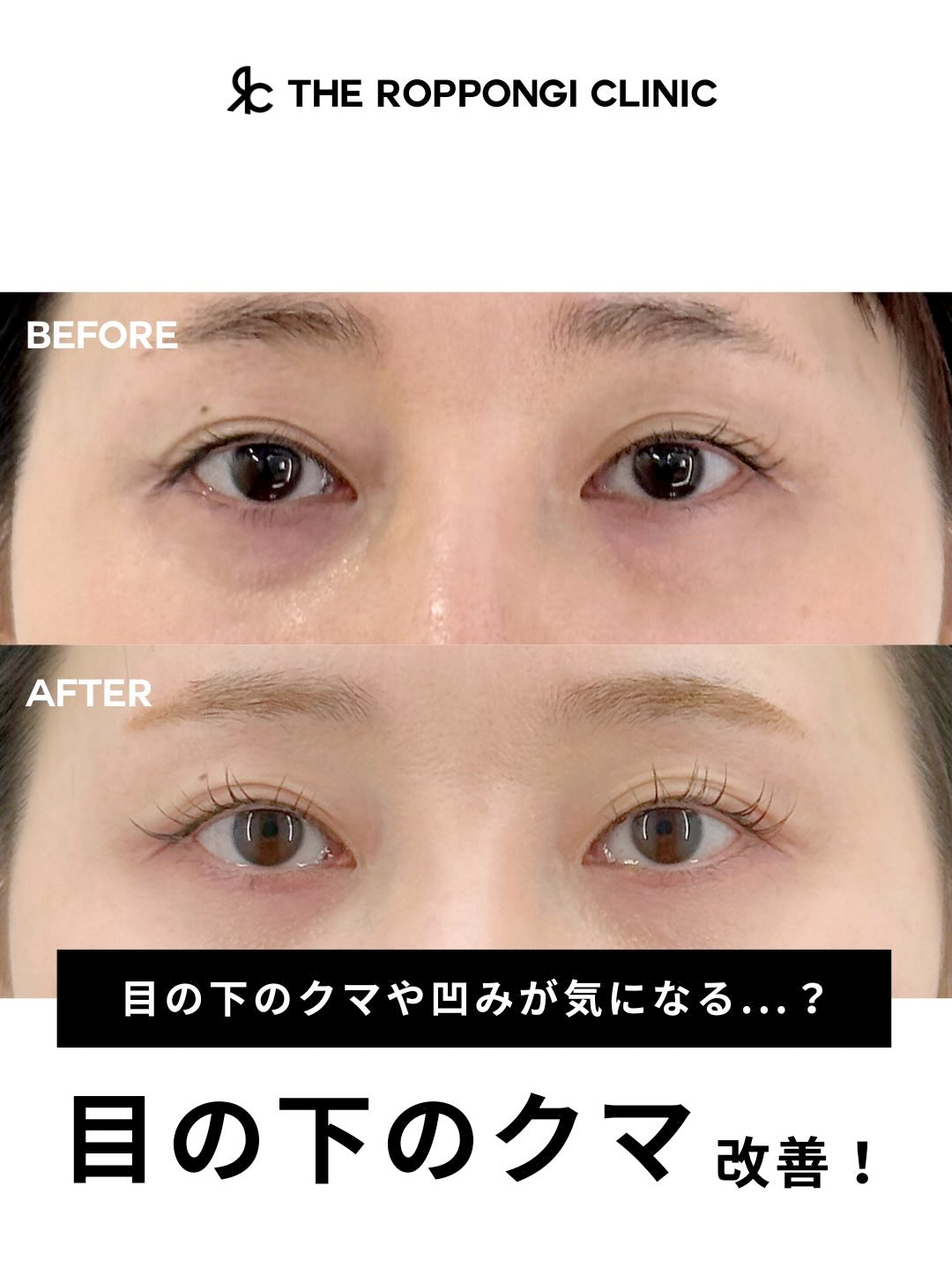 【目の下のクマ改善】目の下のクマや凹みが気になる?