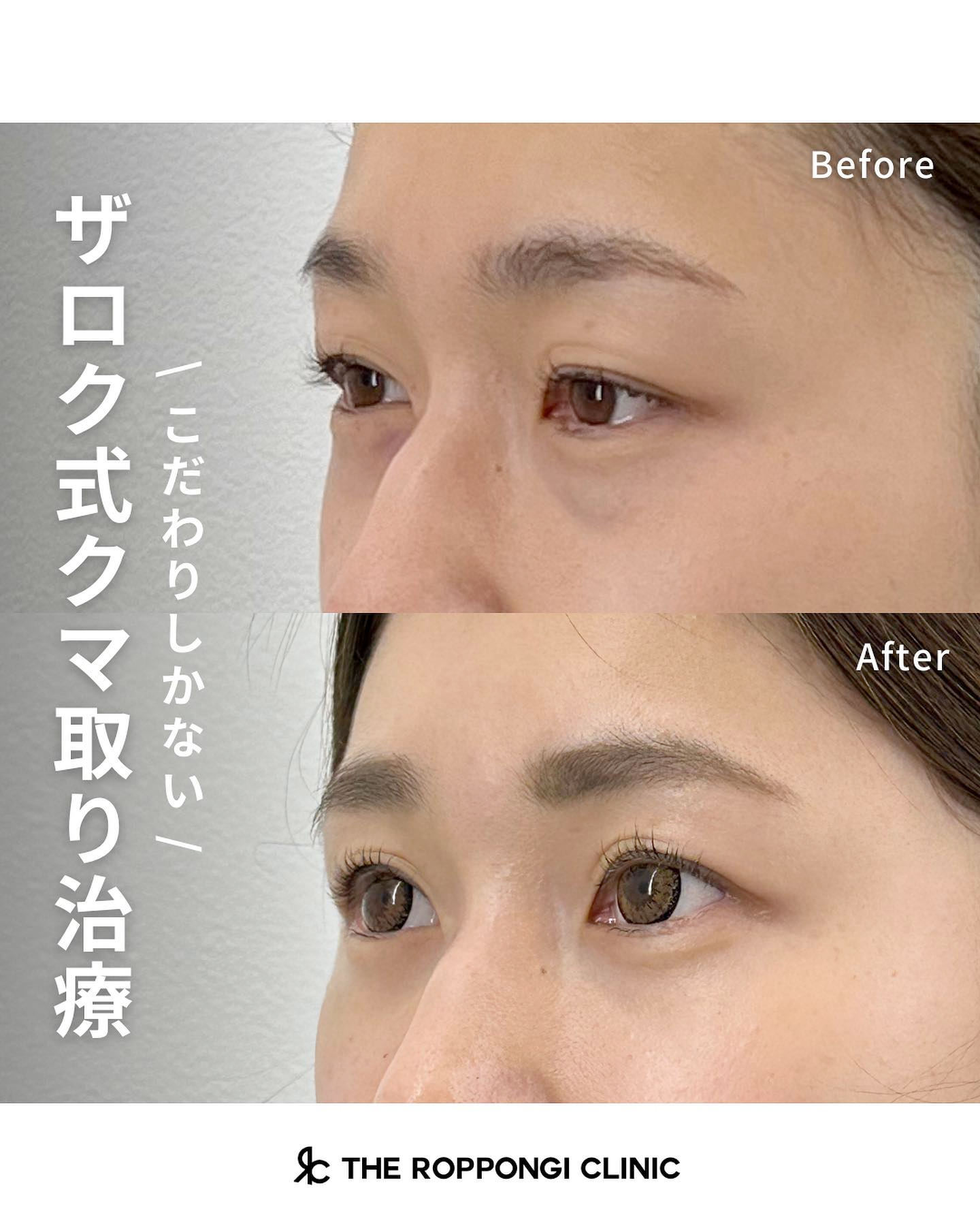 ザロク式目の下のクマ取り治療