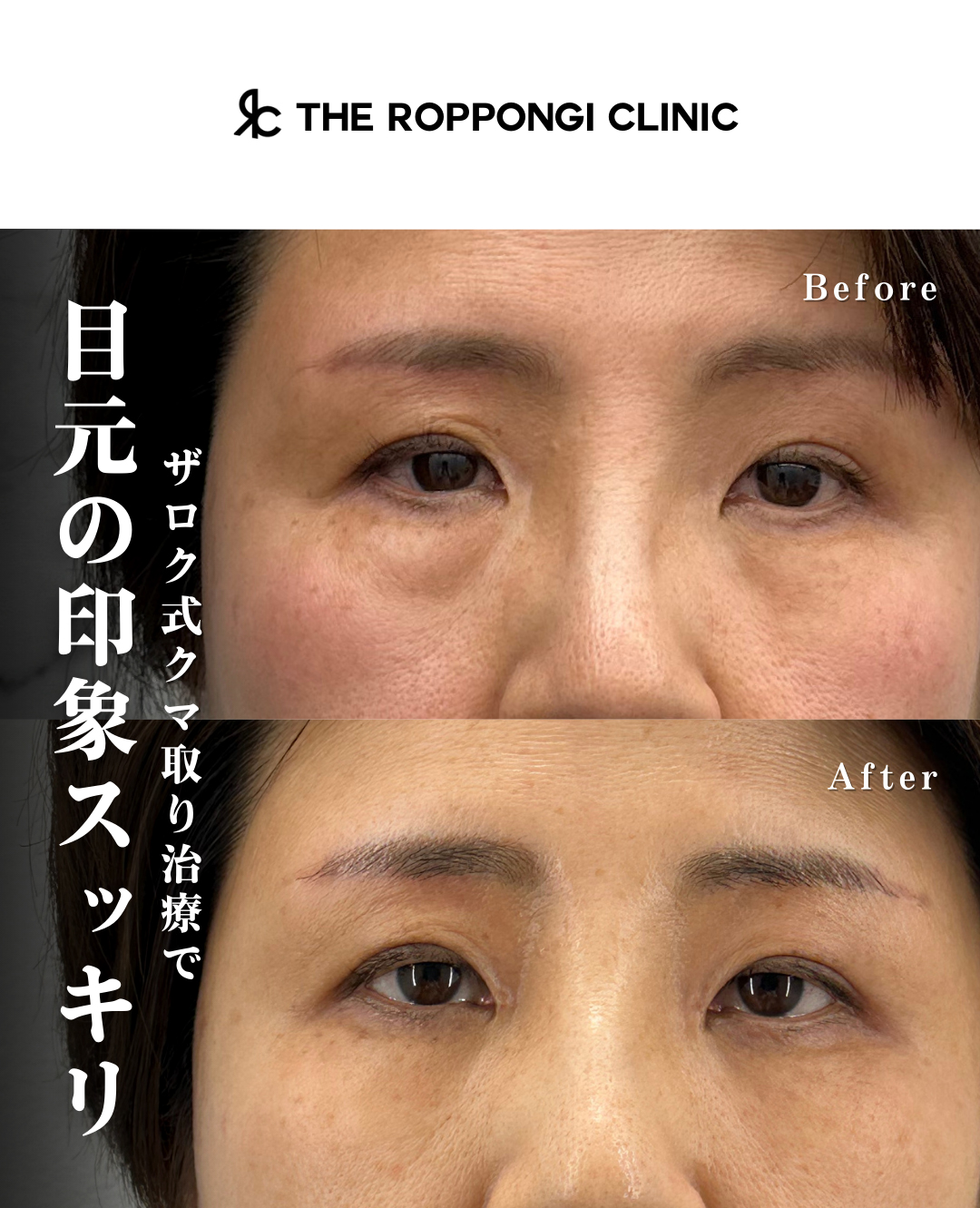 ザロク式クマ取り治療で目元の印象スッキリ