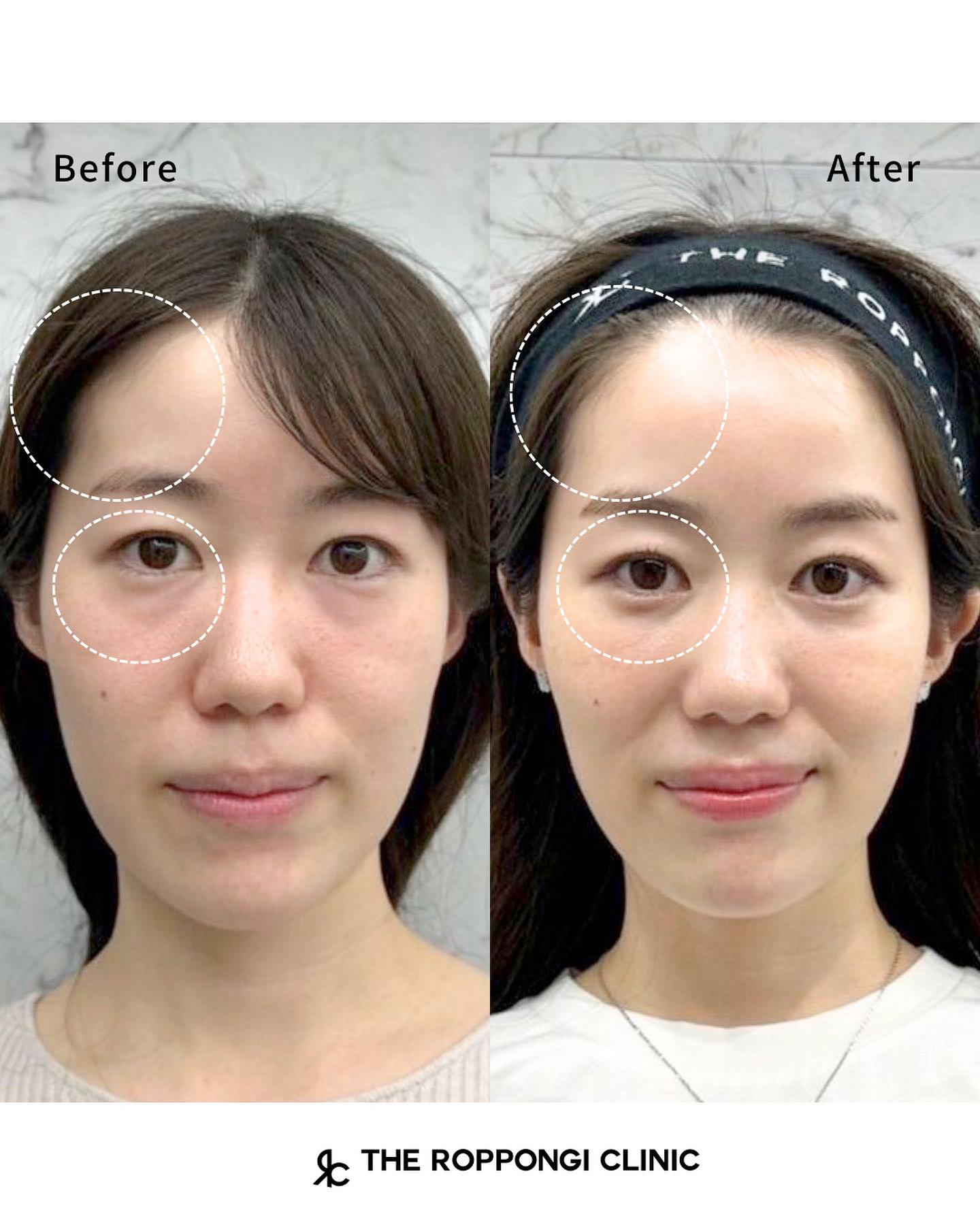 目の下のクマ治療、脱脂