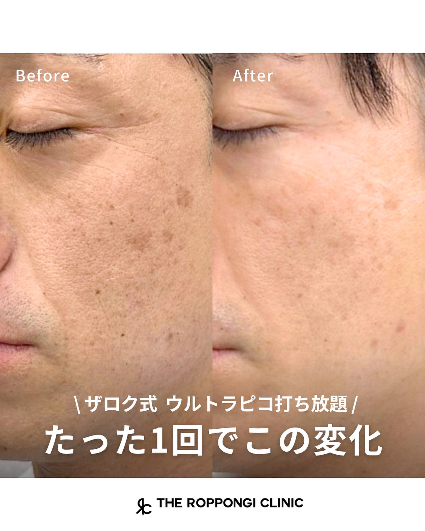 シミ治療、ピコレーザー