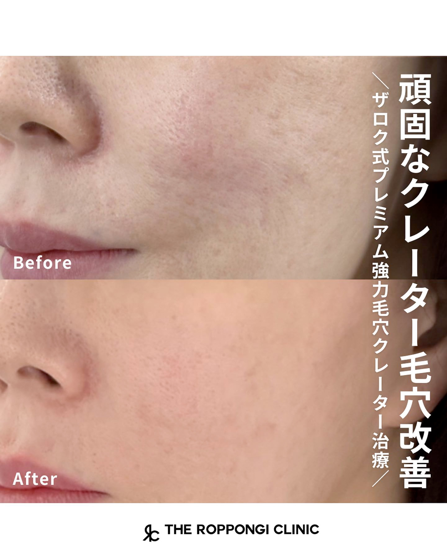 頑固なクレーター毛穴改善治療