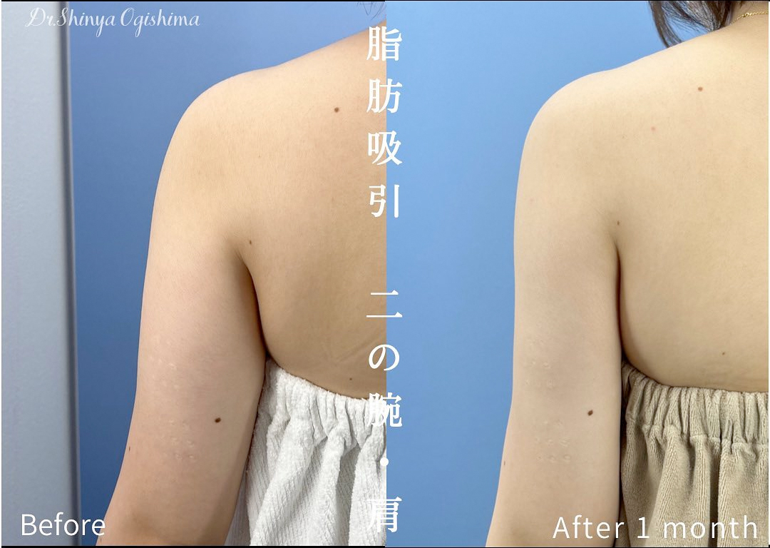 二の腕の脂肪吸引