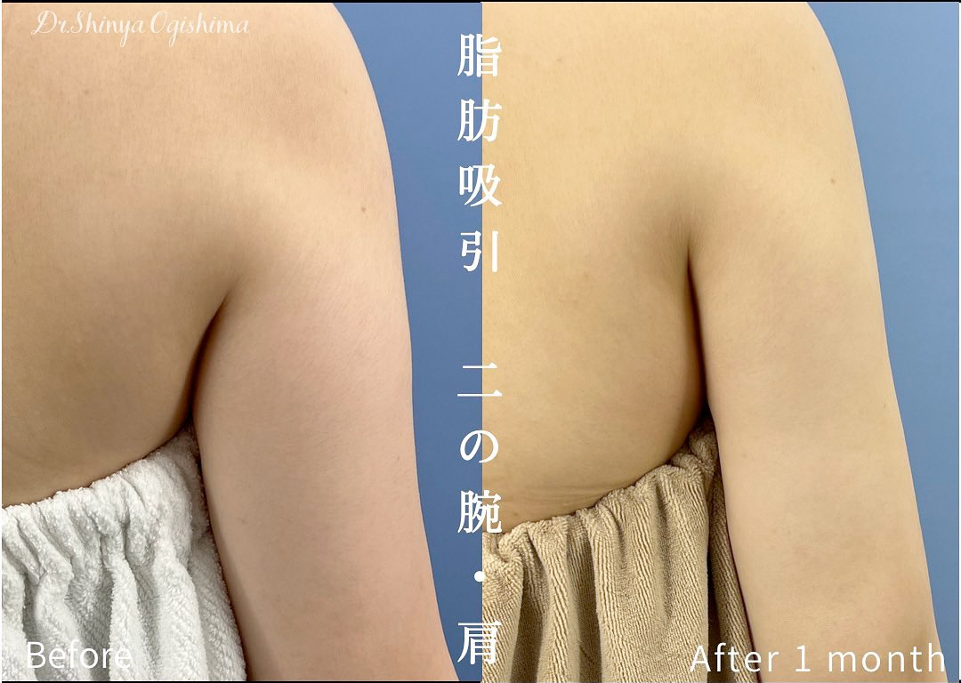 二の腕の脂肪吸引