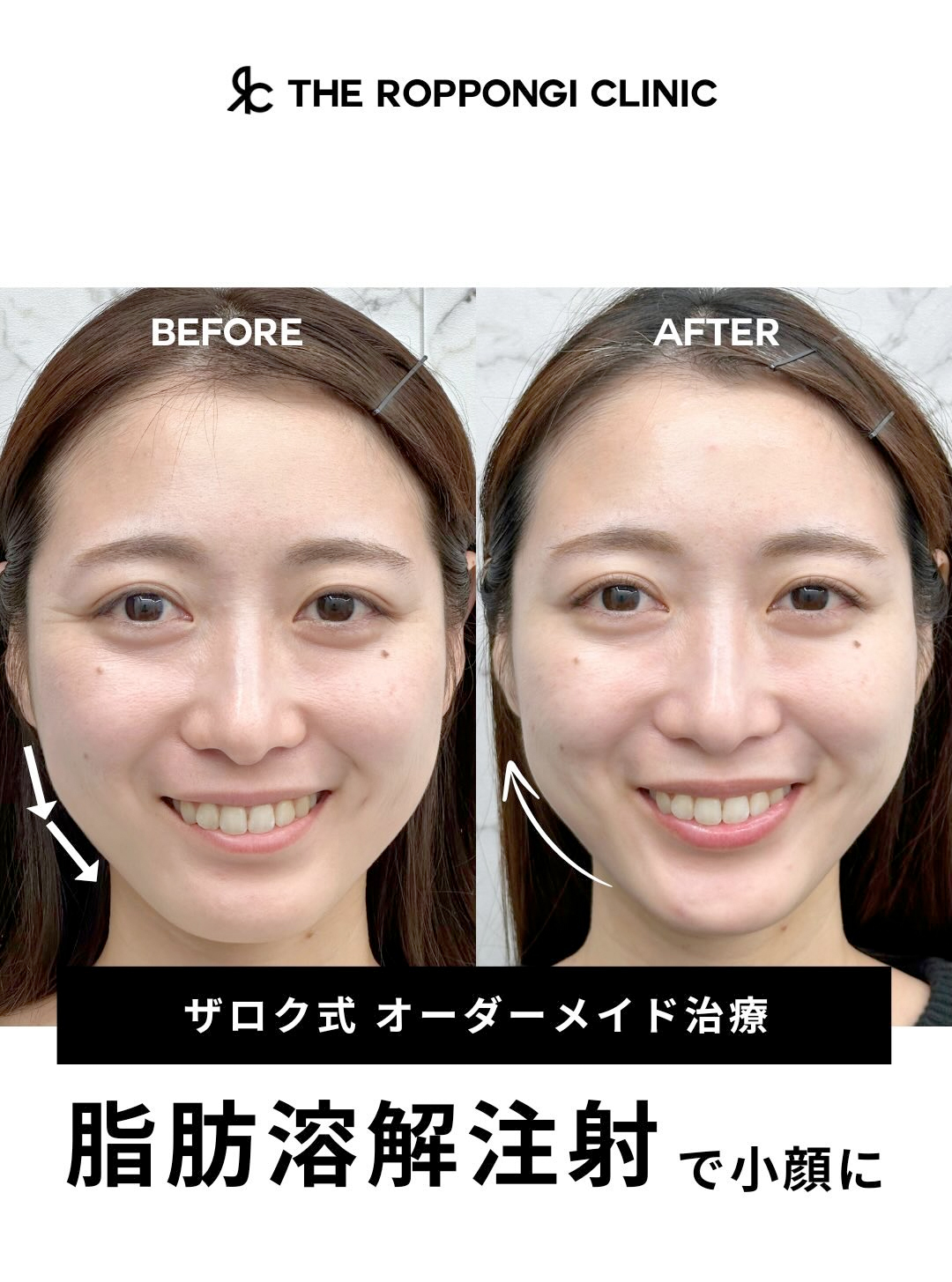 【ザロク式オーダーメイド注射】脂肪溶解注射で小顔に