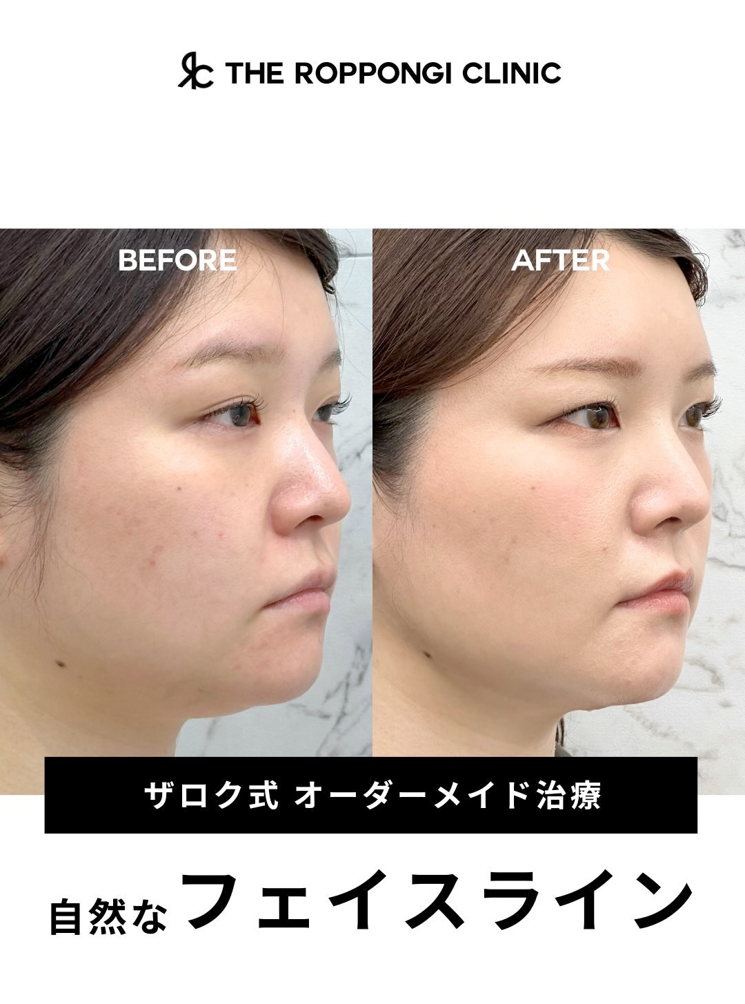 【ザロク式オーダーメイド治療】自然なフェイスライン