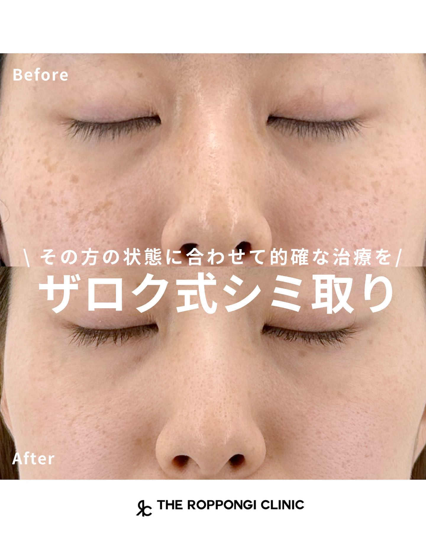 その方の状態に合わせて的確な治療を【ザロク式シミ取り】