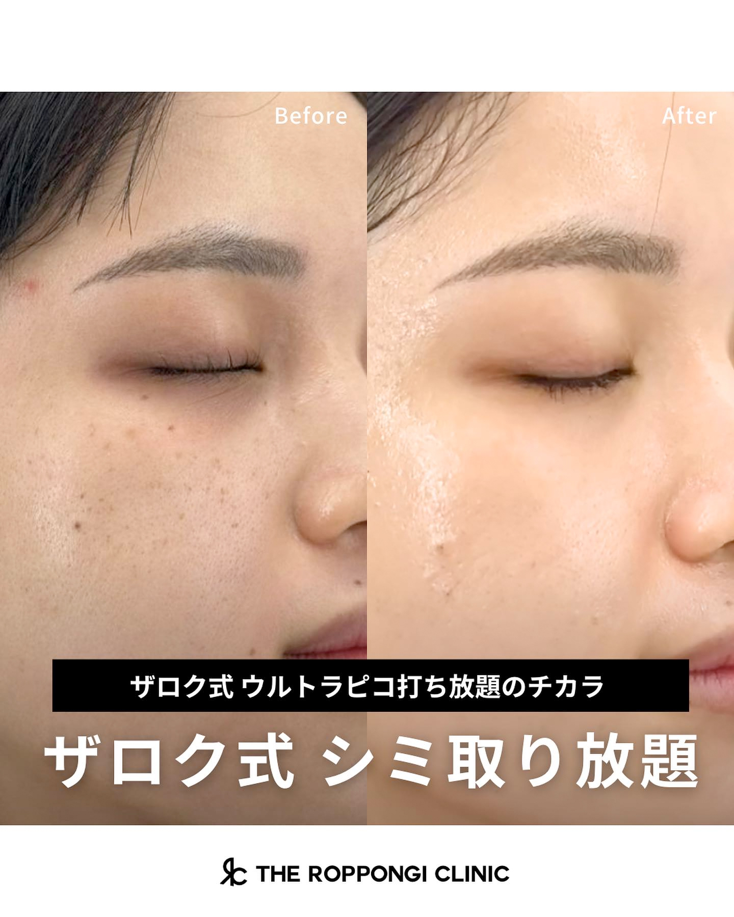 【ザロク式ウルトラピコ打ち放題のチカラ】ザロク式シミ取り放題