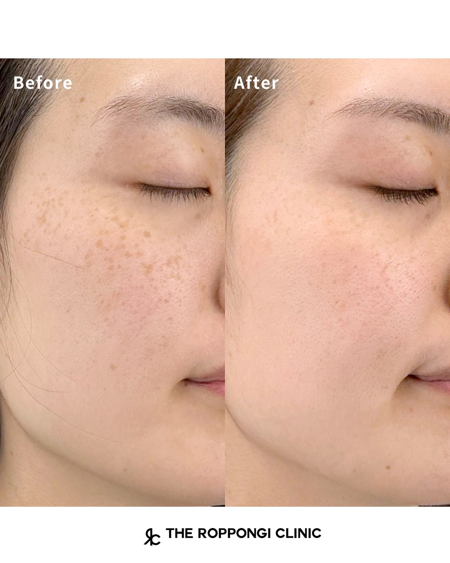 シミ取り ピコレーザー