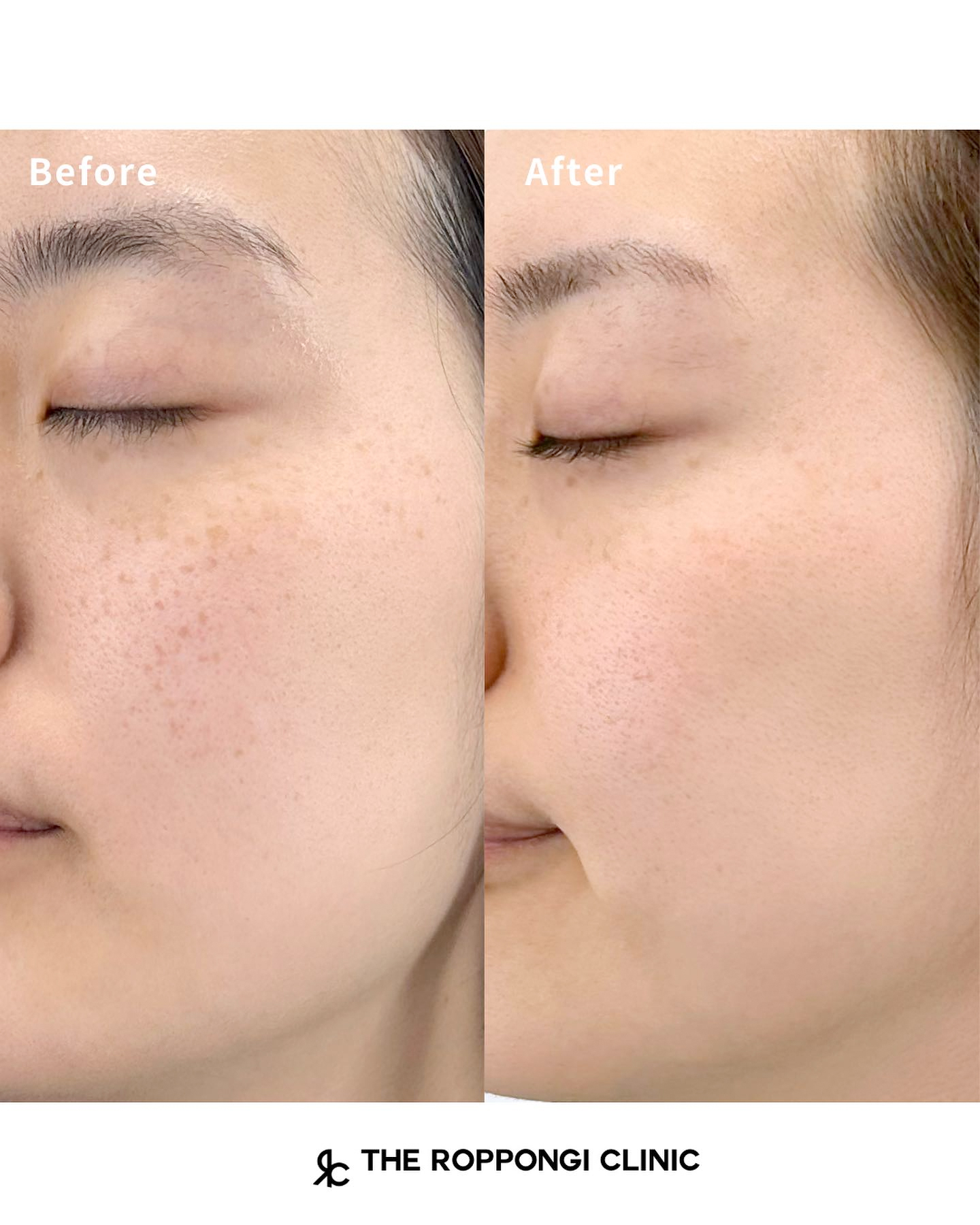 シミ取り ピコレーザー