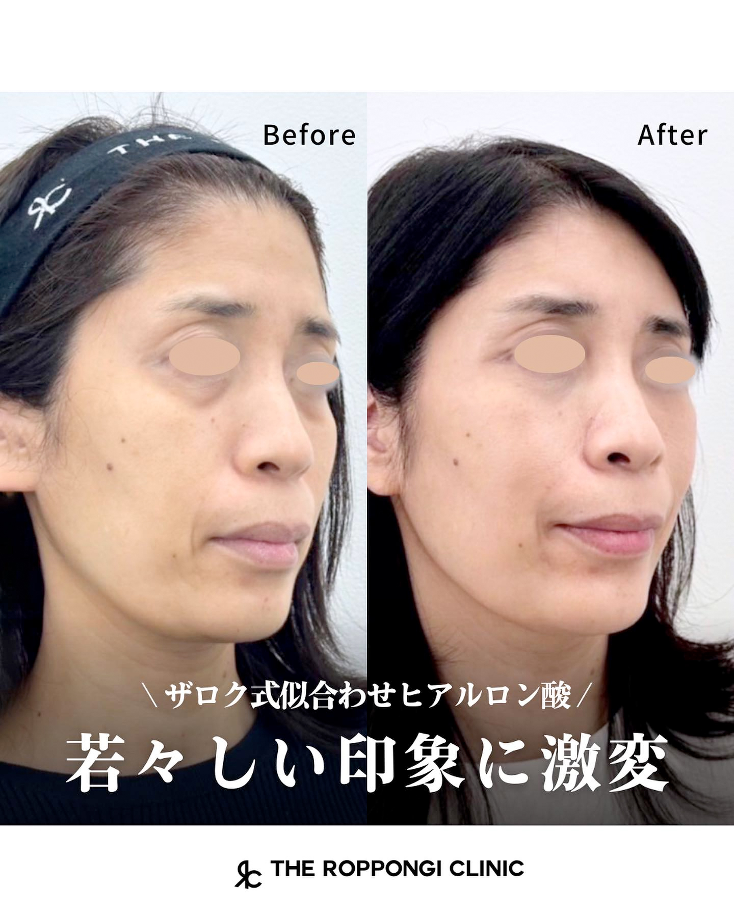 【ザロク式似合わせヒアルロン酸®︎】若々しい印象に激変