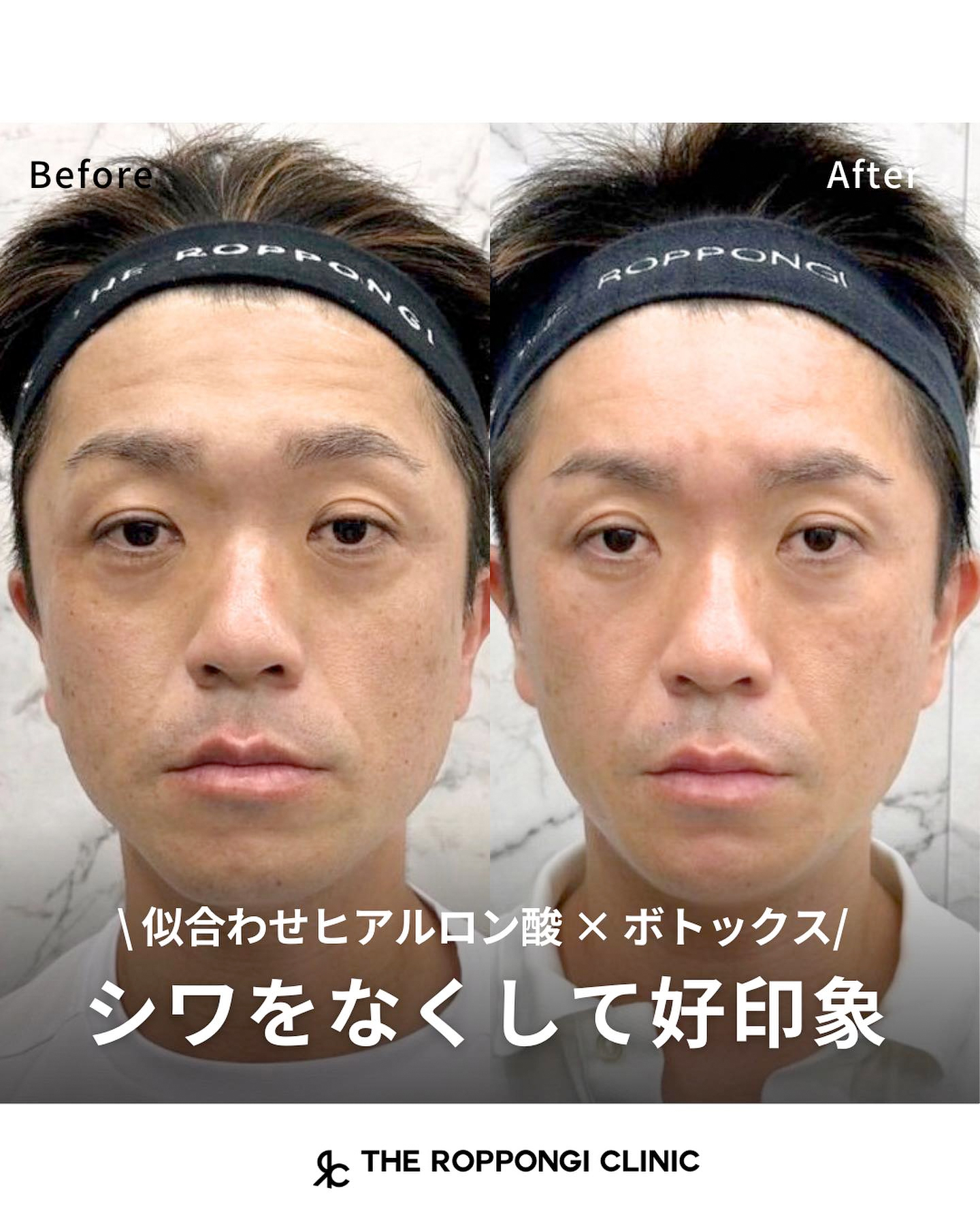 ザロク式似合わせヒアルロン酸®︎×ボトックス注射でシワを無くして好印象に