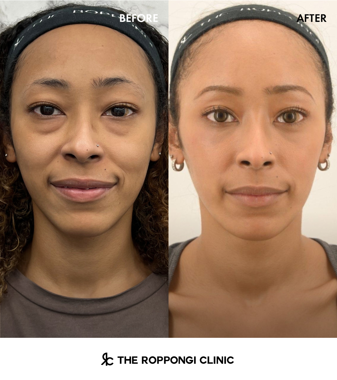 脱脂+脂肪注入『クマは、無くせる』