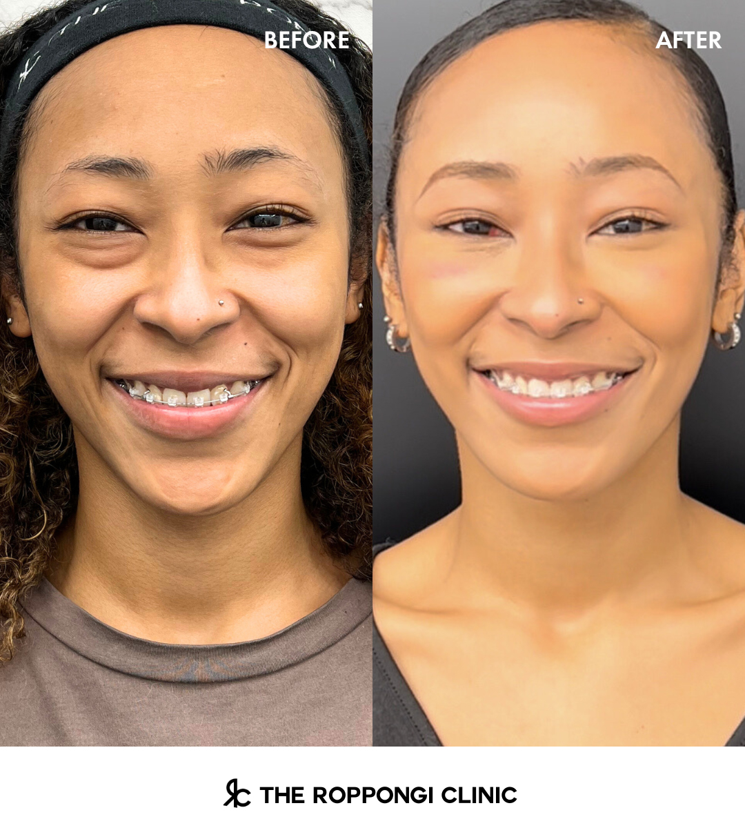 脱脂+脂肪注入『目の下のクマは、無くせる』