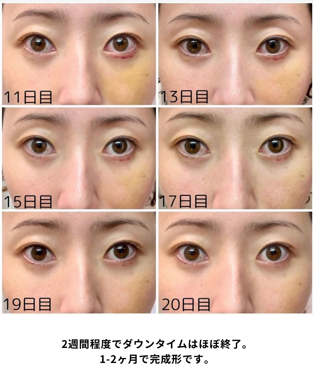 ザロク式 脱脂術 ダウンタイム経過まとめ①