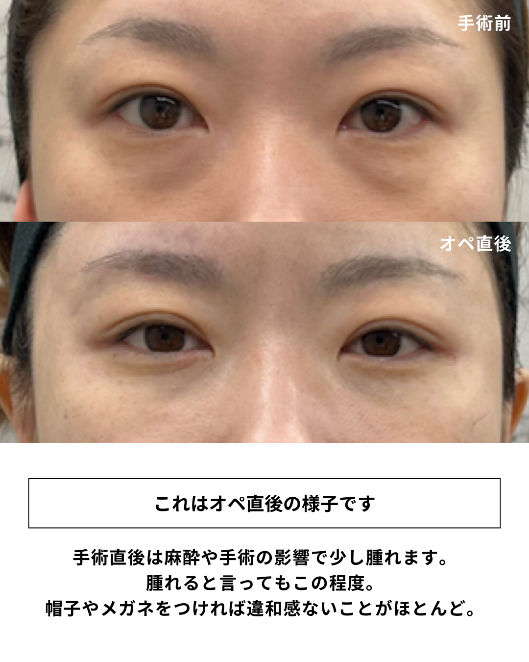 ザロク式 脱脂術 ダウンタイム経過まとめ②