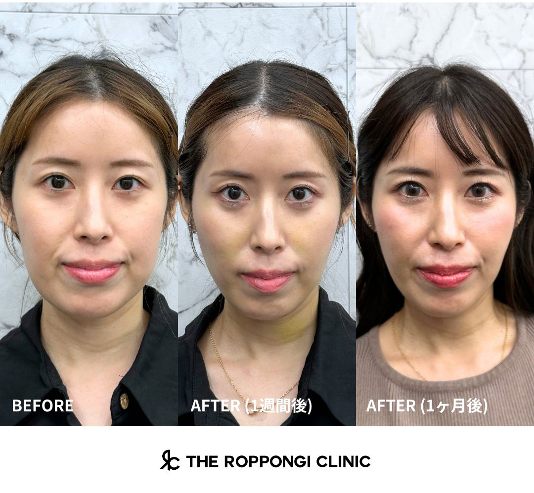 脂肪吸引ダウンタイム経過 想像以上に短いダウンタイム?!