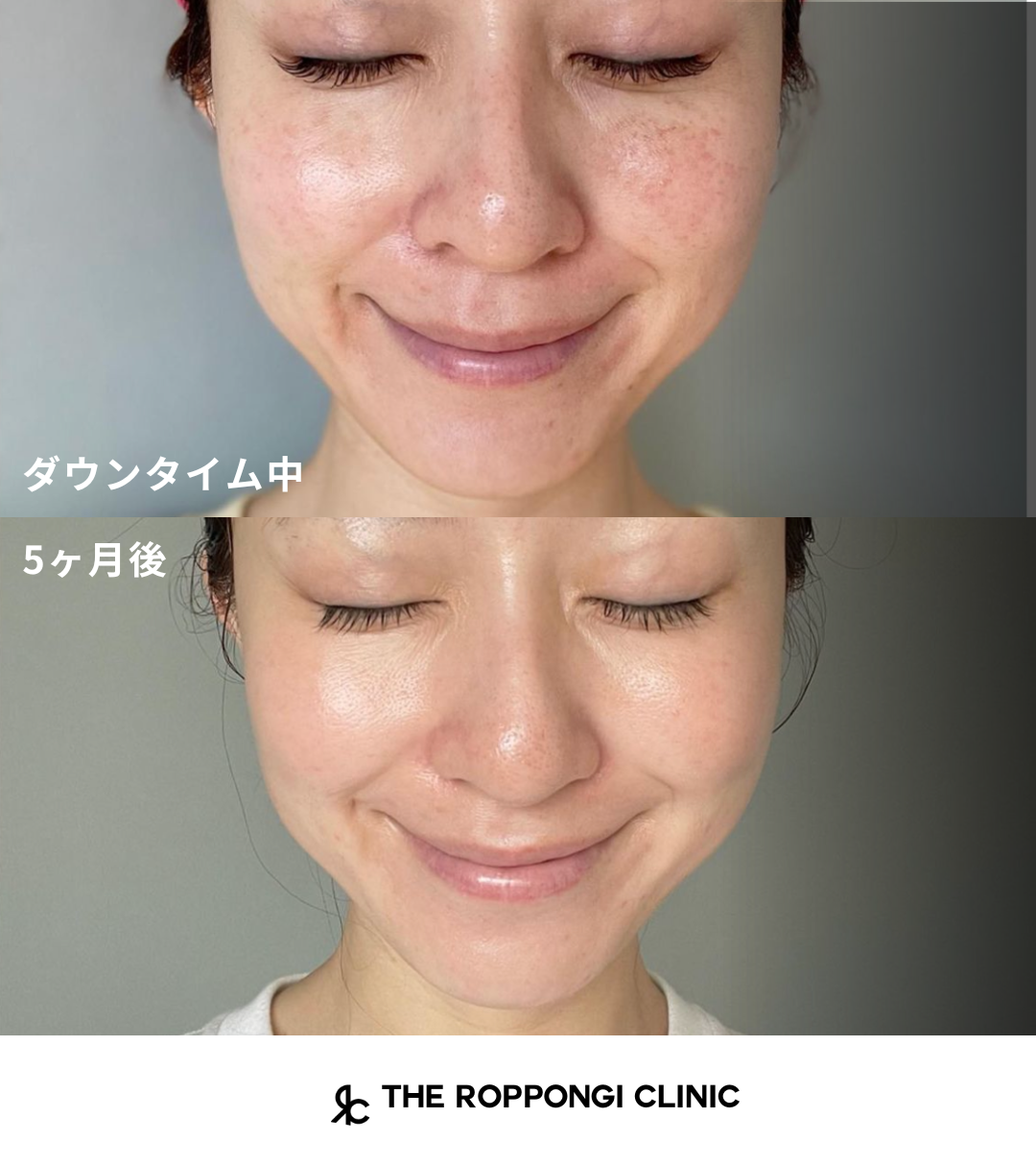 ザロク式ウルトラピコ打ち放題