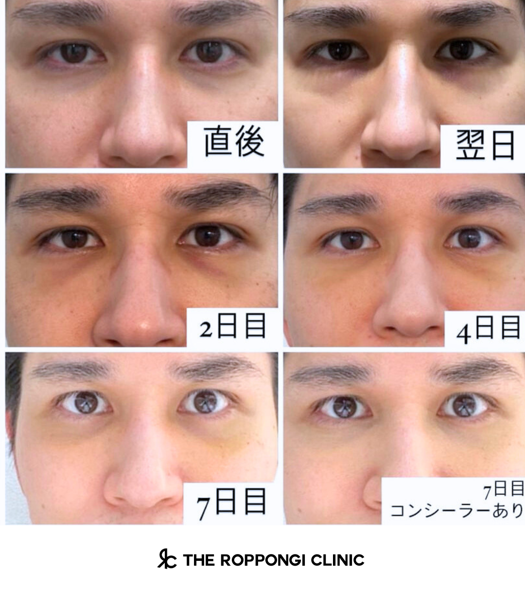 ザロク式 脱脂術 ダウンタイム経過まとめ③