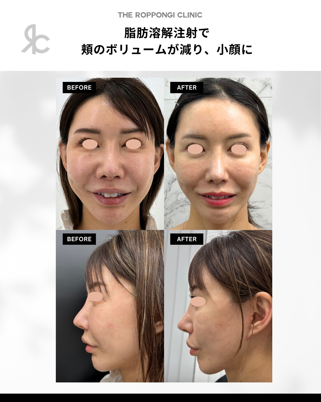 ザロクの脂肪溶解注射は効果最大