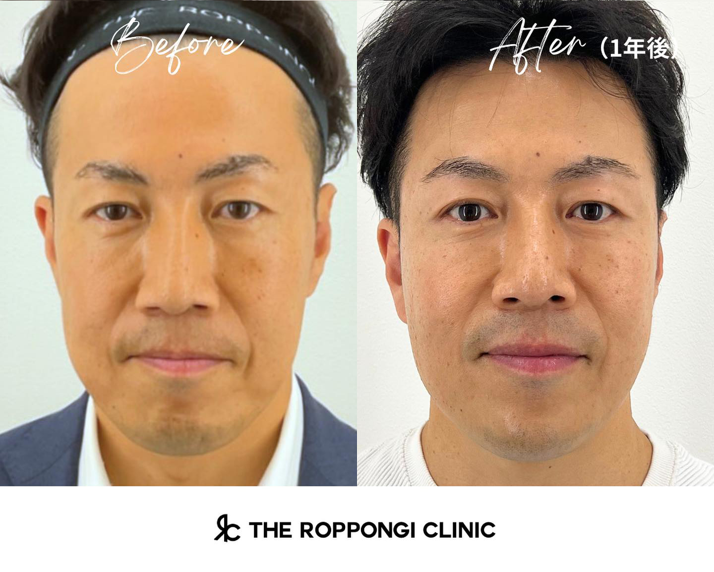 男性美容、バッカルファット、ヒアルロン酸注入、糸リフト